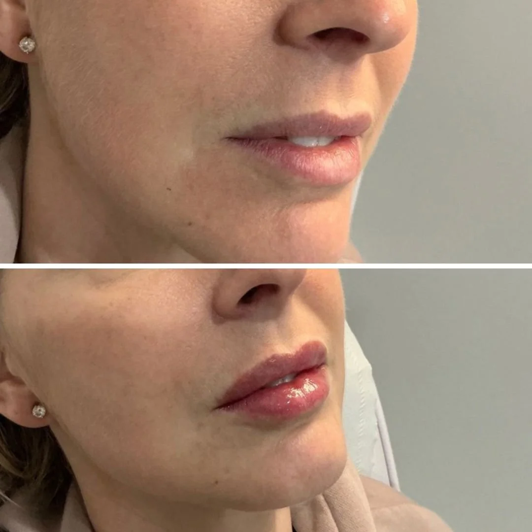 Before and after results showing subtle, natural enhancement following aesthetic treatment.
