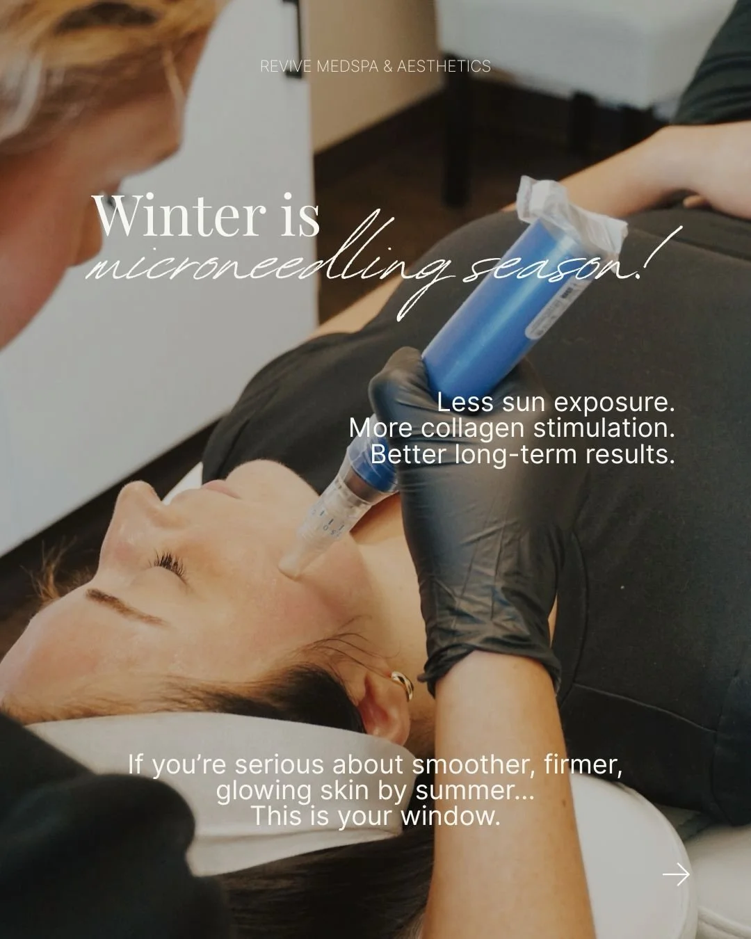 All of this =
✔️ Reduced risk of post-inflammatory hyperpigmentation
✔️ Better collagen stimulation
✔️ Safer recovery

Treat now. Glow by spring. Shine by summer ☀️
Book your consultation to start your series 🤍

#medicalaesthetics #skinpenmicroneedl
