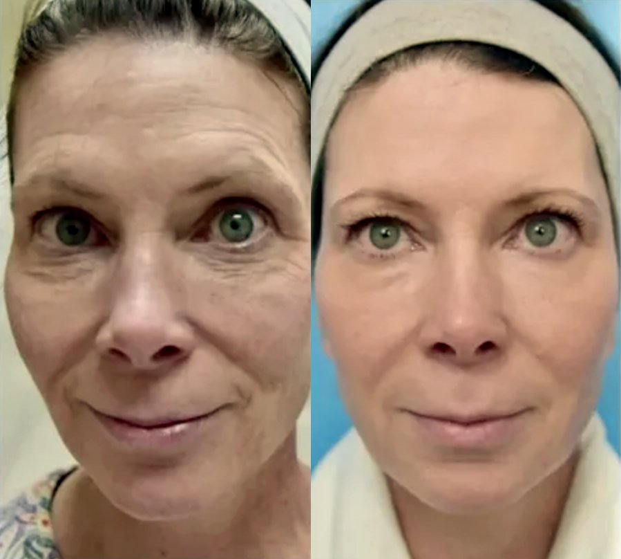 Comparison of a woman's face before and after skincare, showing reduced wrinkles and smoother skin.