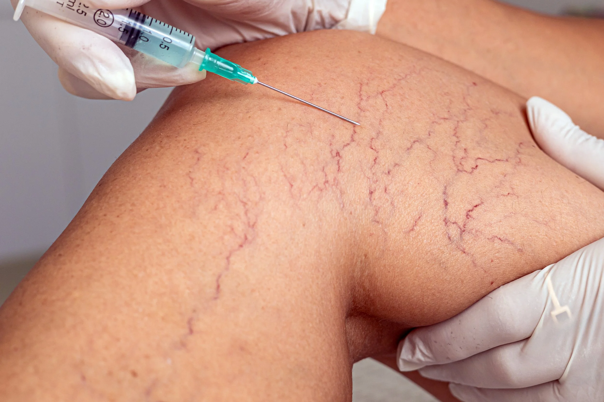 Close-up of a person receiving a sclerotherapy injection on their leg with visible spider veins, held by a medical professional wearing gloves.