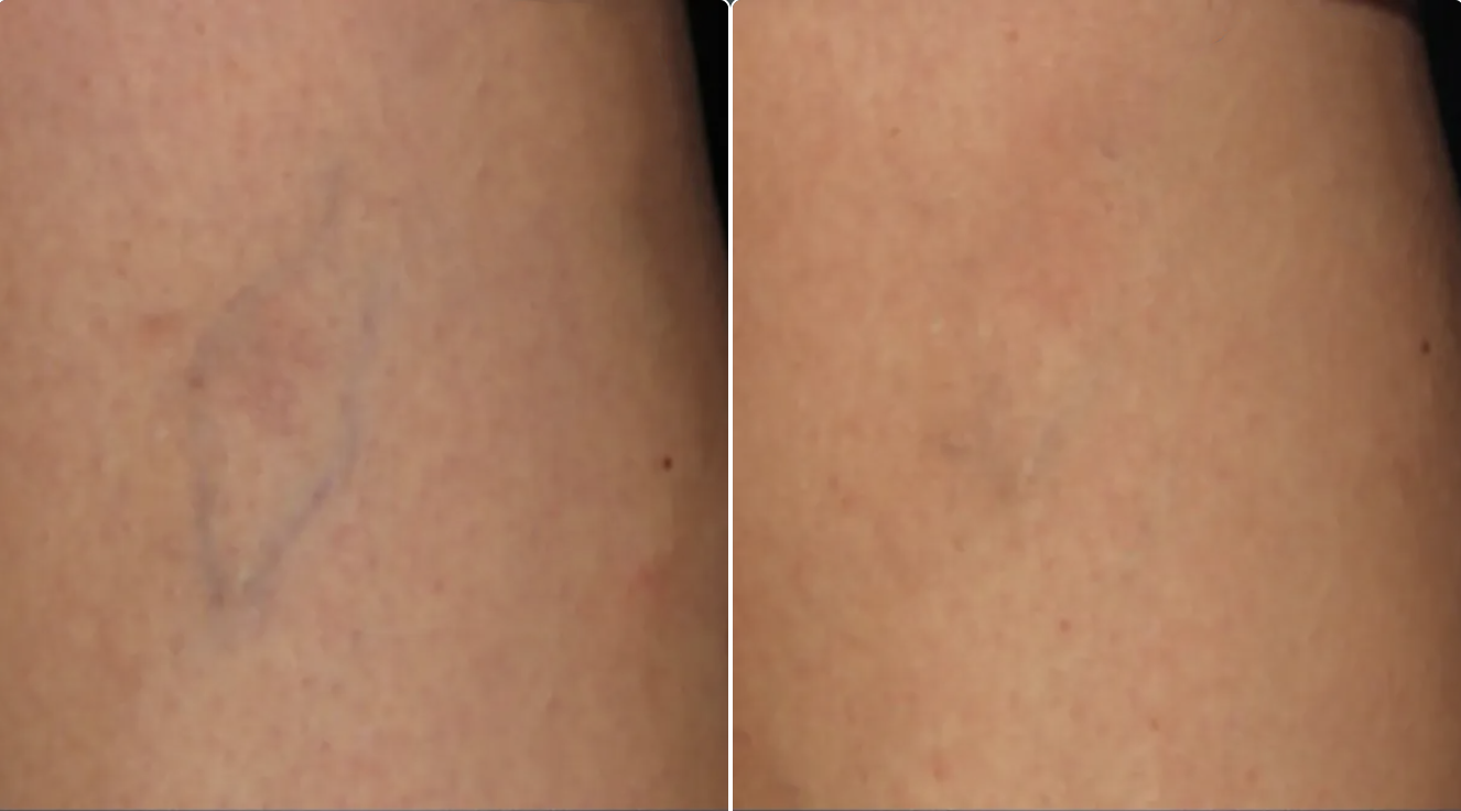 Comparison image showing a scar on skin, with the right side demonstrating healed skin and the left side showing a visible scar.