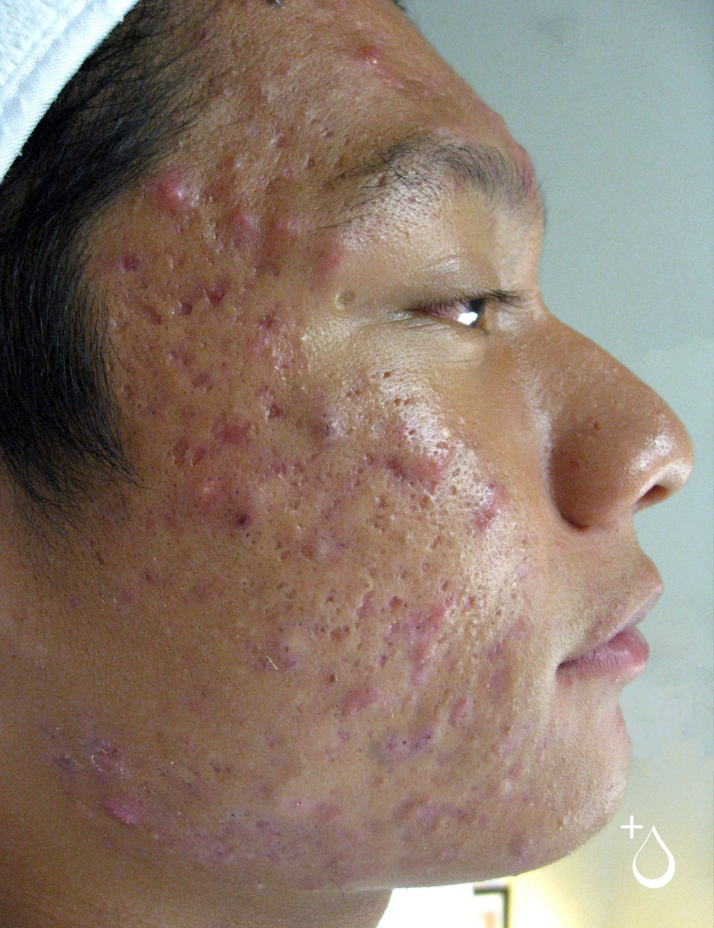 A woman preparing a vaccine or injection, wearing blue gloves, in a medical or clinical setting.