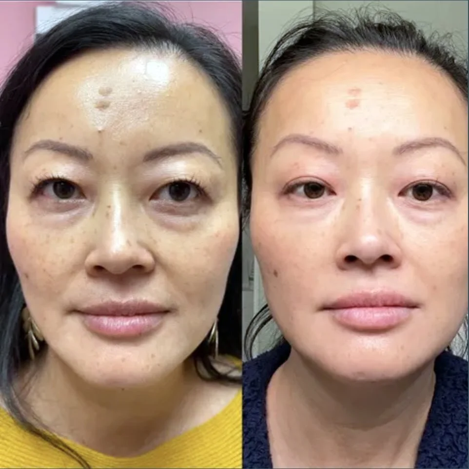 Side-by-side comparison of a woman before and after skincare treatment, showing reduction in skin blemishes, spots, and improved skin texture.
