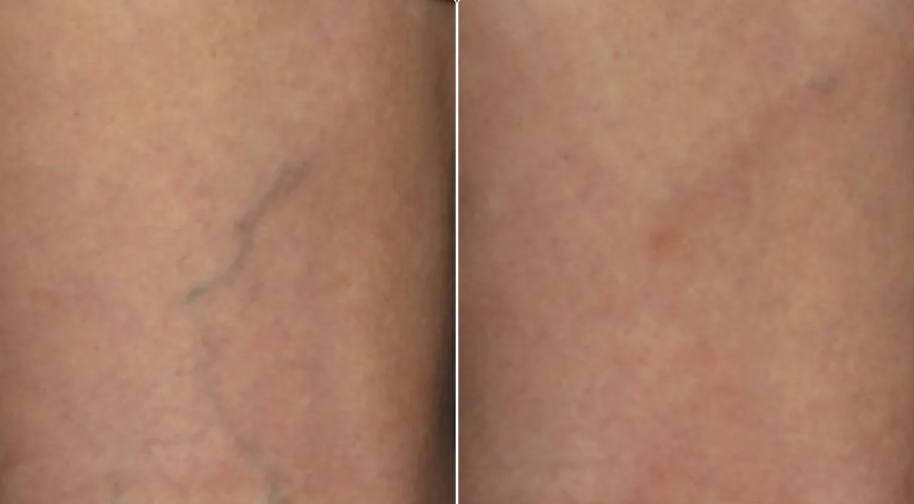 A close-up of a person's skin showing a before and after comparison of a healed incision or scar, with minimal visible marks on the right side.