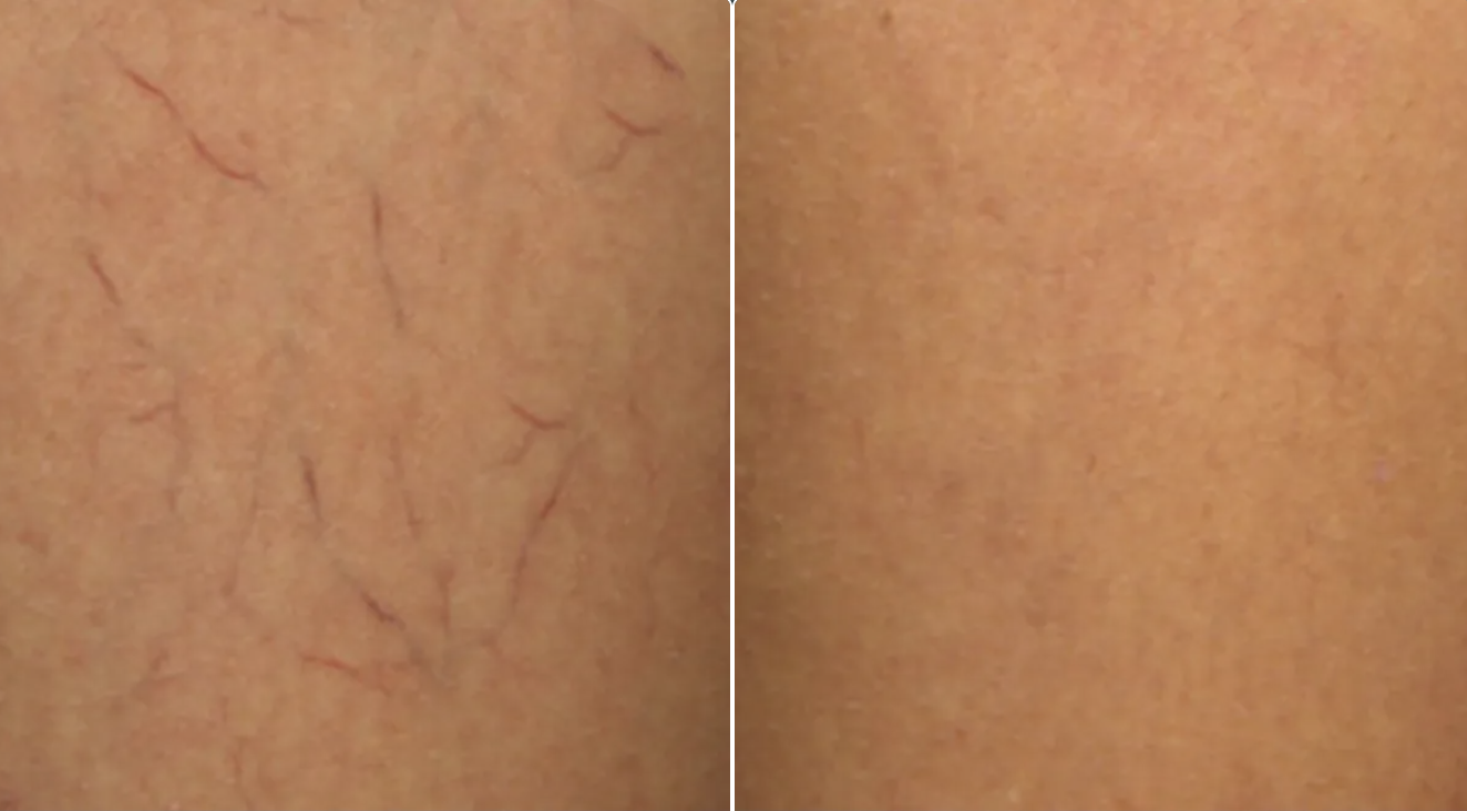 Close-up of skin showing damaged blood vessels on the left and smooth skin on the right.