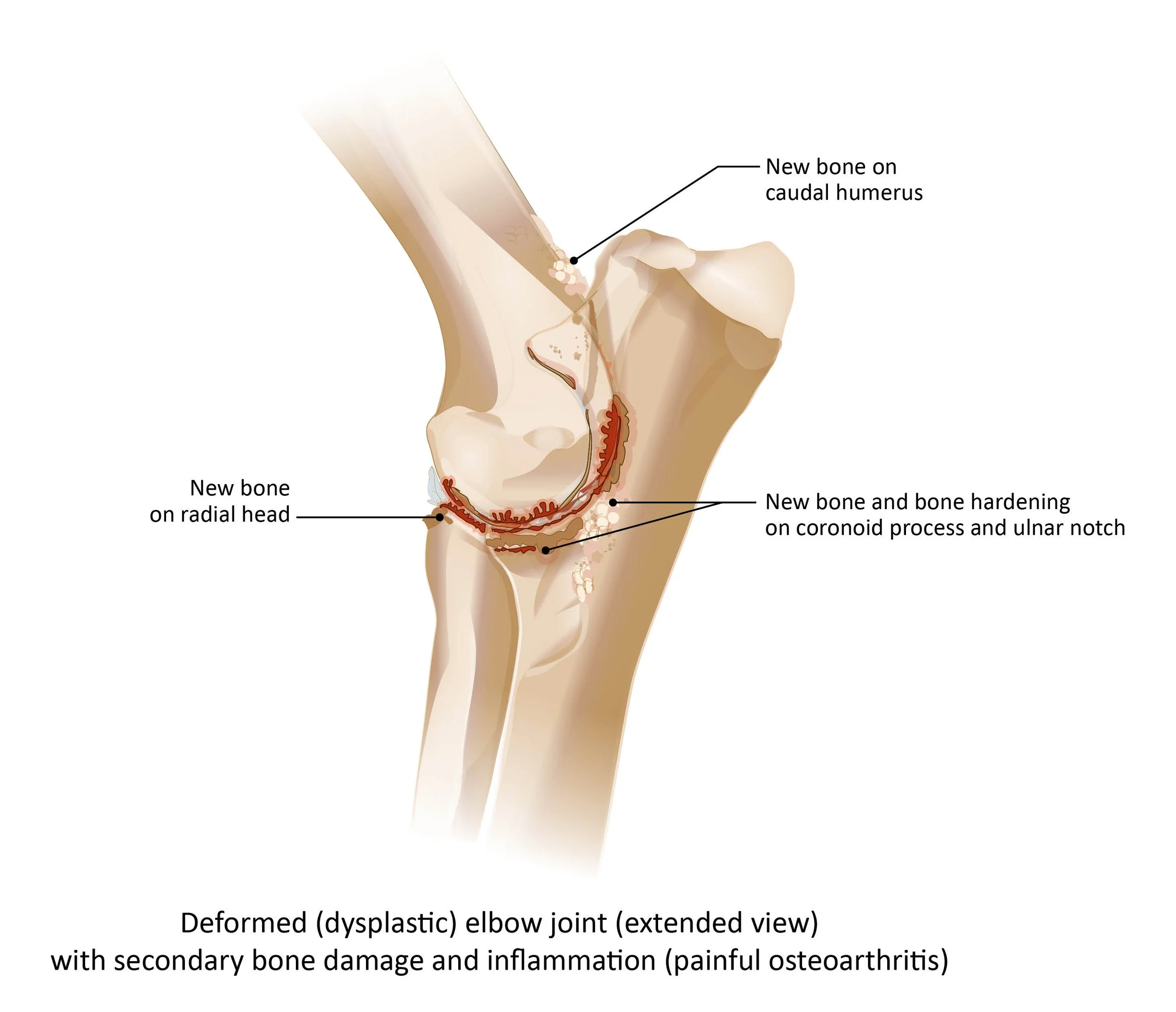 Dysplastic elbow joint (extended)