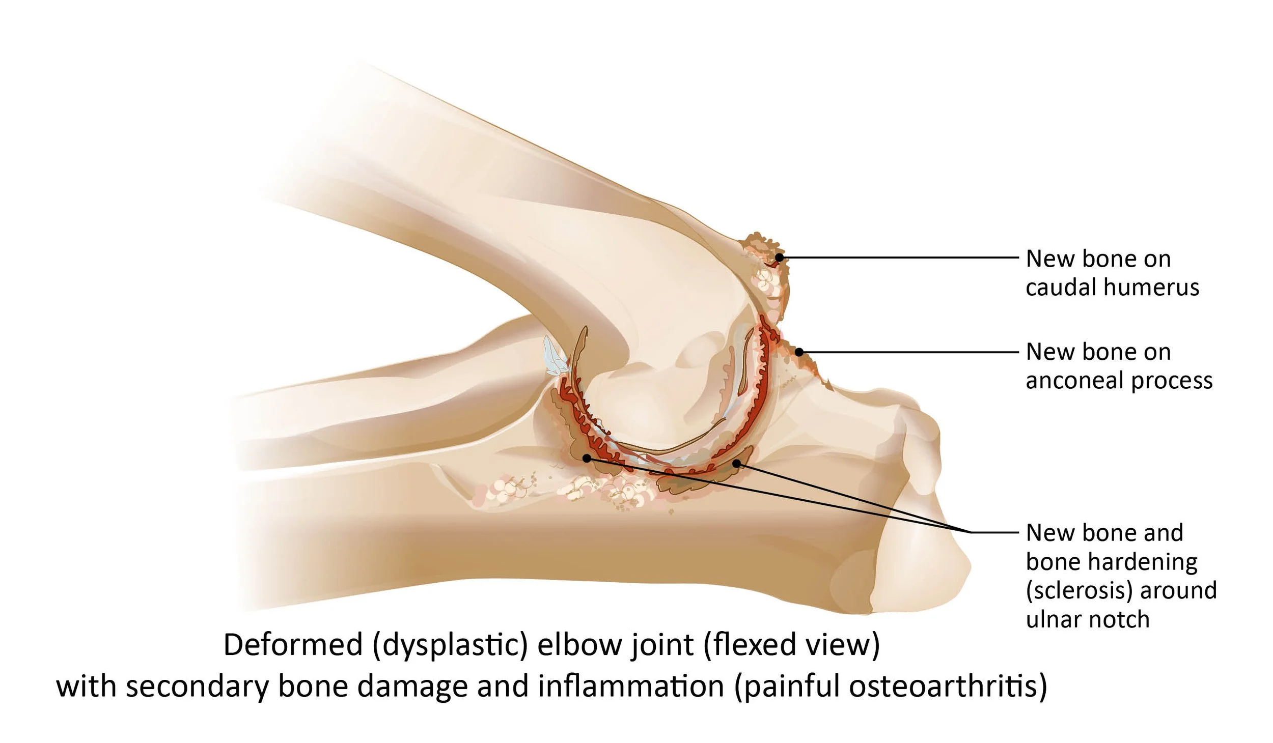 Dysplastic elbow joint (flexed)