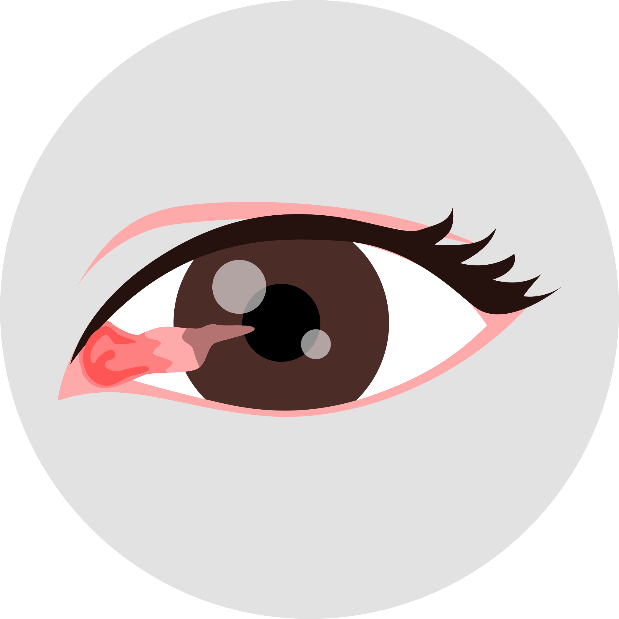 Illustration of a human eye with a pterygium.