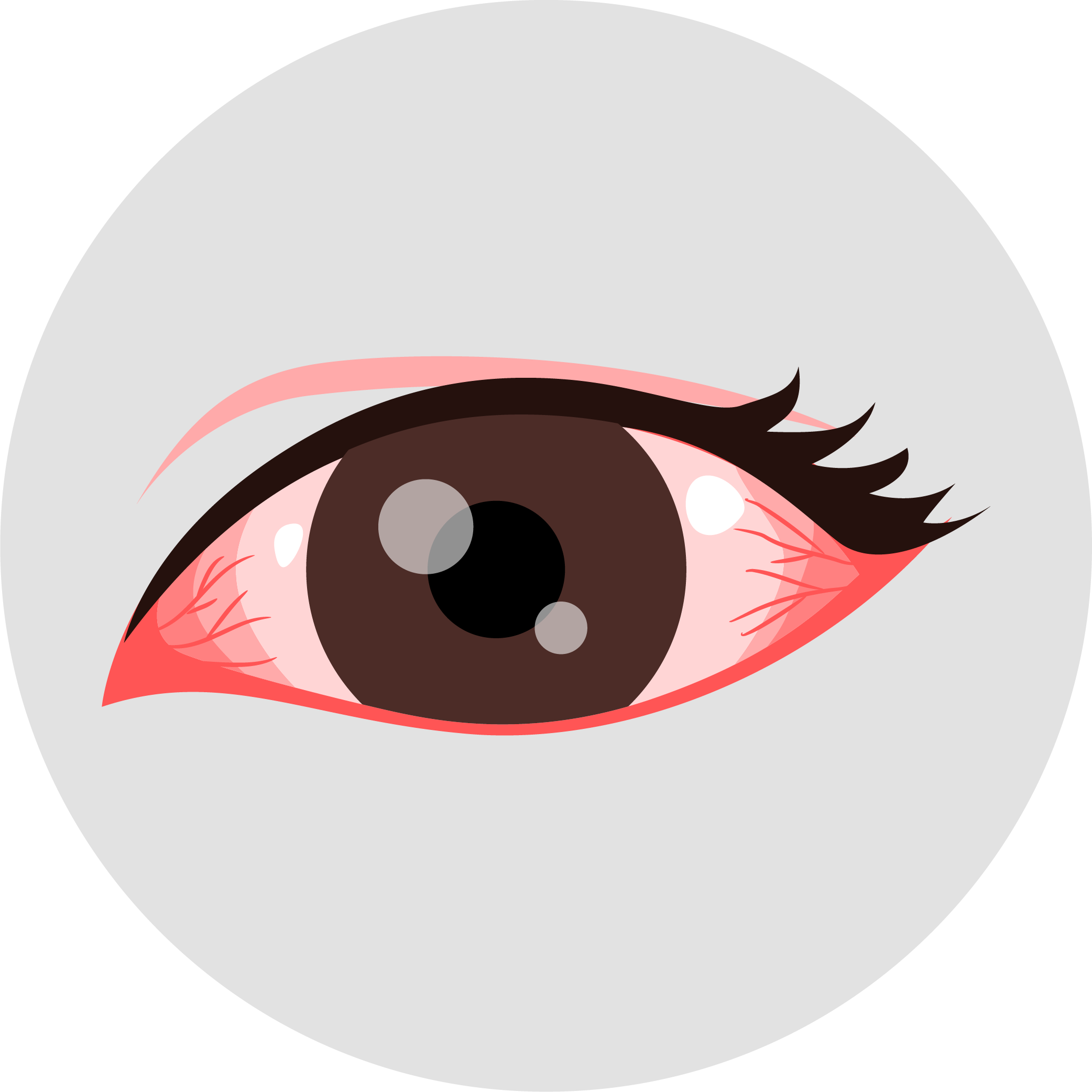Illustration of a human eye with a pink sclera, depicting glaucoma.