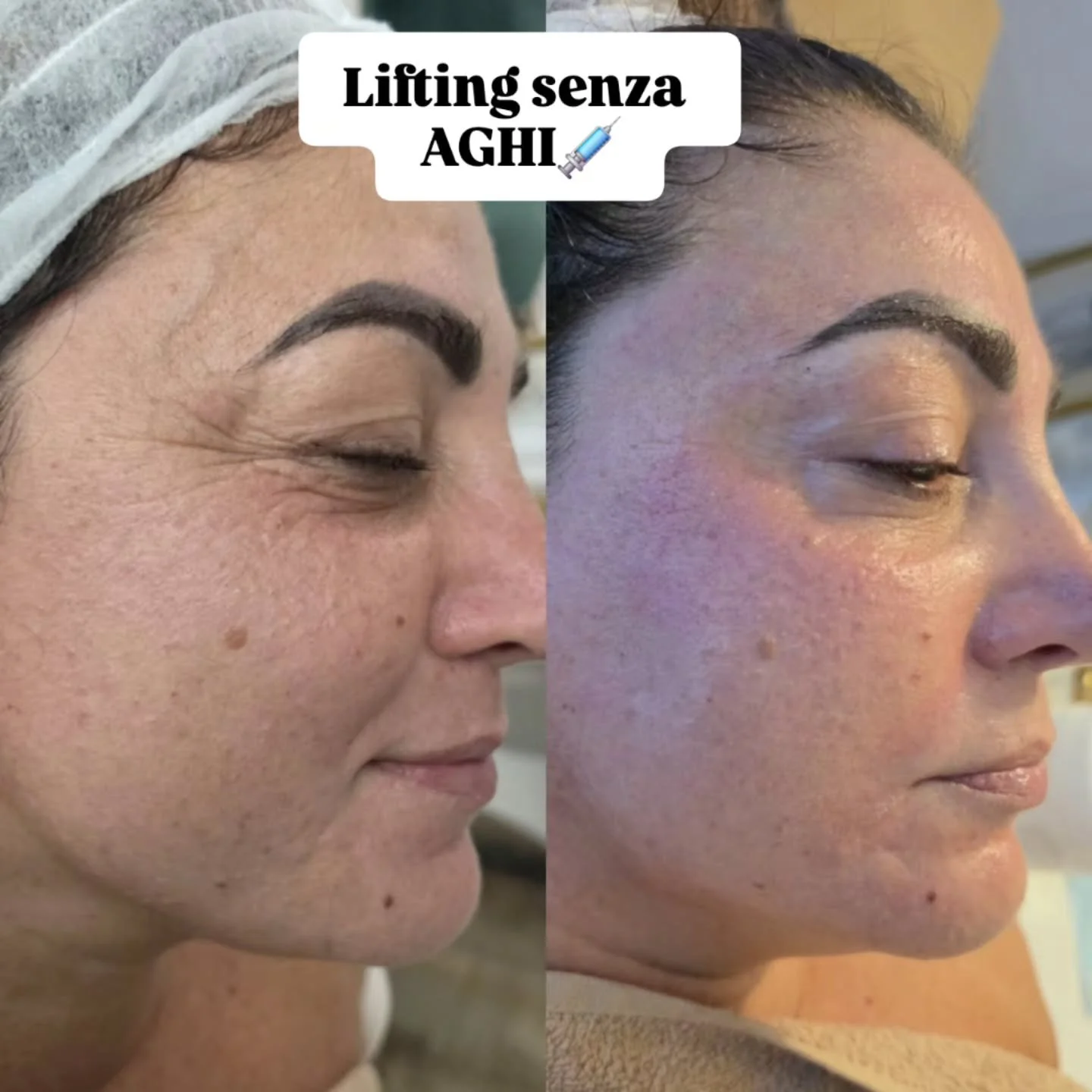 🔥LIFTING SENZA AGHI
TUTTI PAZZI PER FUSION IONIC! ✨🔥

💖 Il nuovo trattamento di biorivitalizzazione FUSION IONIC di Nasiha che sta conquistando tutte! 😍

✨ Rughe e segni del tempo visibilmente attenuati
💎 Effetto GLOW immediato
💧 Pelle dall'asp