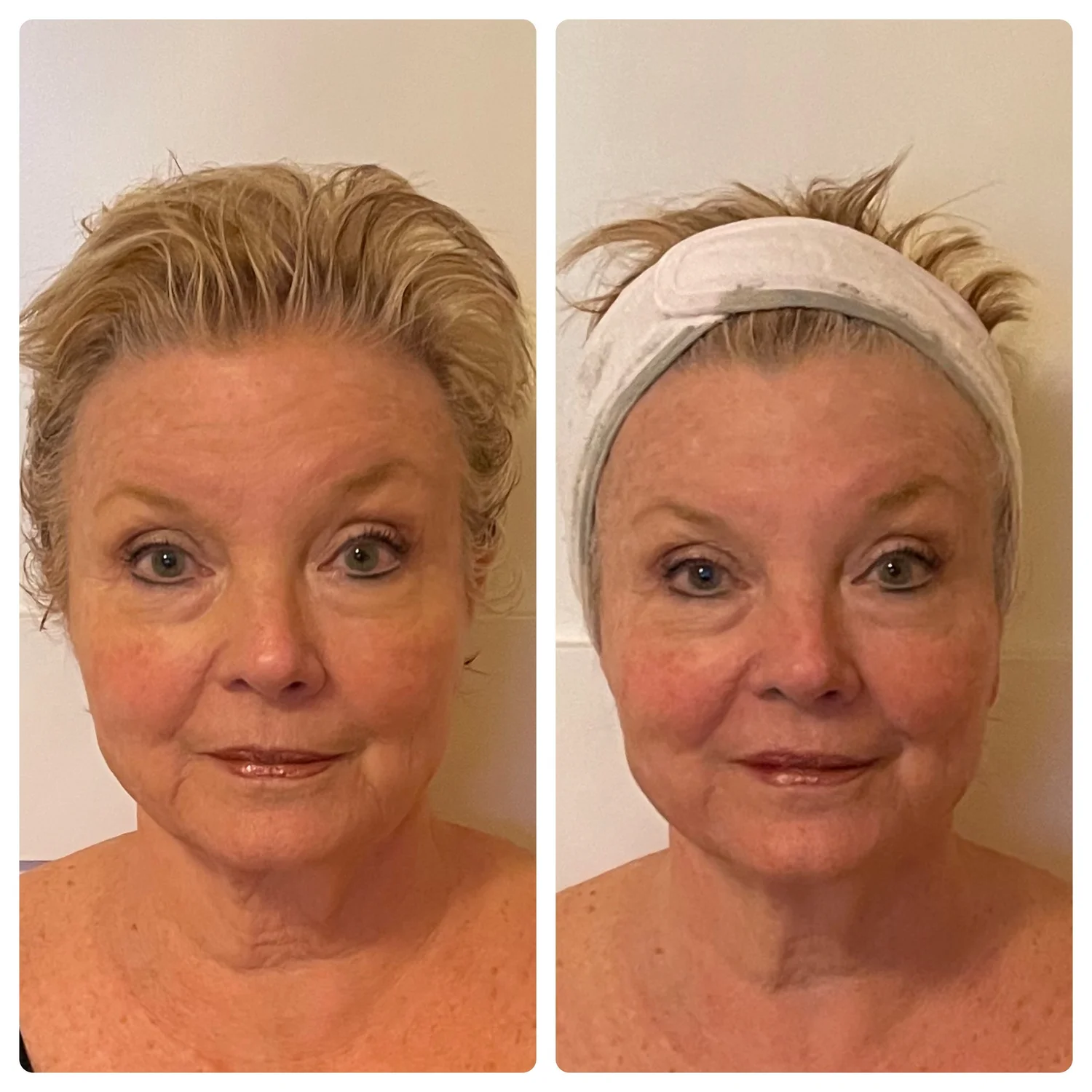 Natural Facelift before and after — lifted, rejuvenated appearance without surgery at Below Zero Spa Rochester NY area