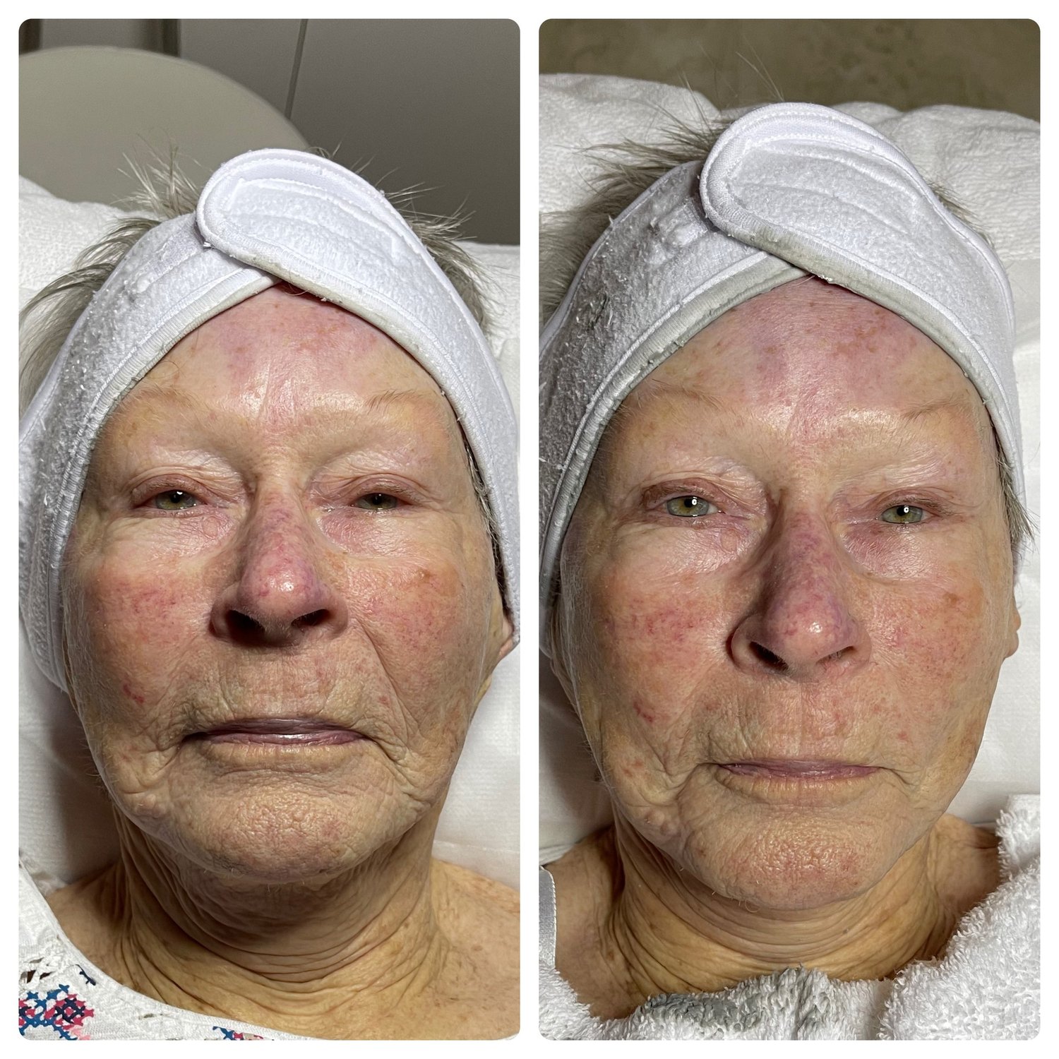 Natural Facelift before and after — visibly tighter, younger-looking skin with non-surgical facial lifting at Below Zero Spa