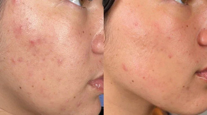 Before_After_Mobile_Acne.jpg