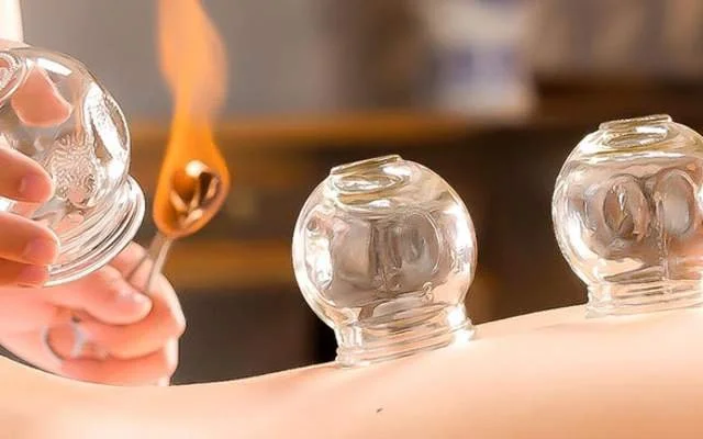 A person holding a tool with flame on the end to light a glass cupping jar with other cupping jars on a person's bare back.