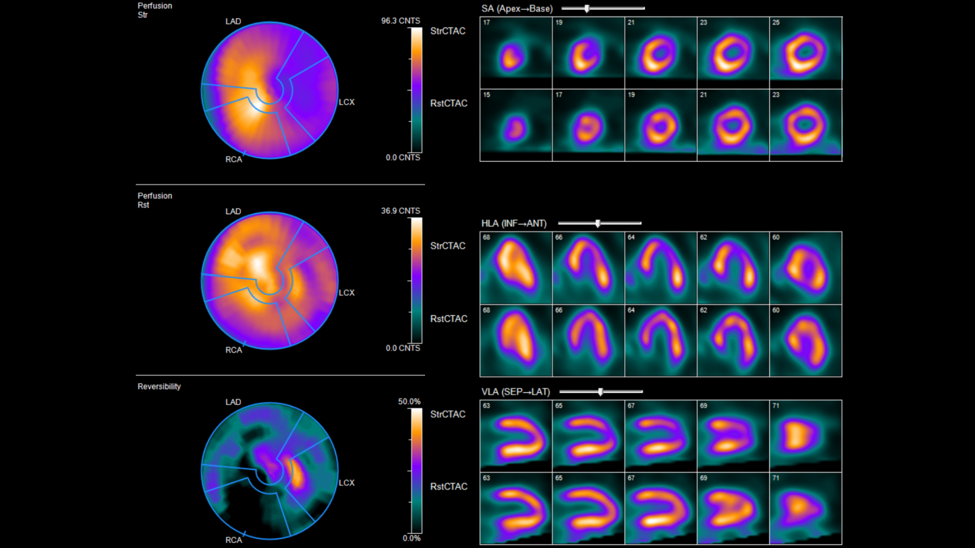 Nuclear Medicine Myocardial Perfusion