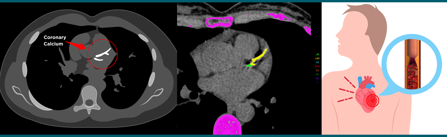 Ct Calcium Study CT Calcium Score | Evaluate Heart Health Today — Reform Radiology