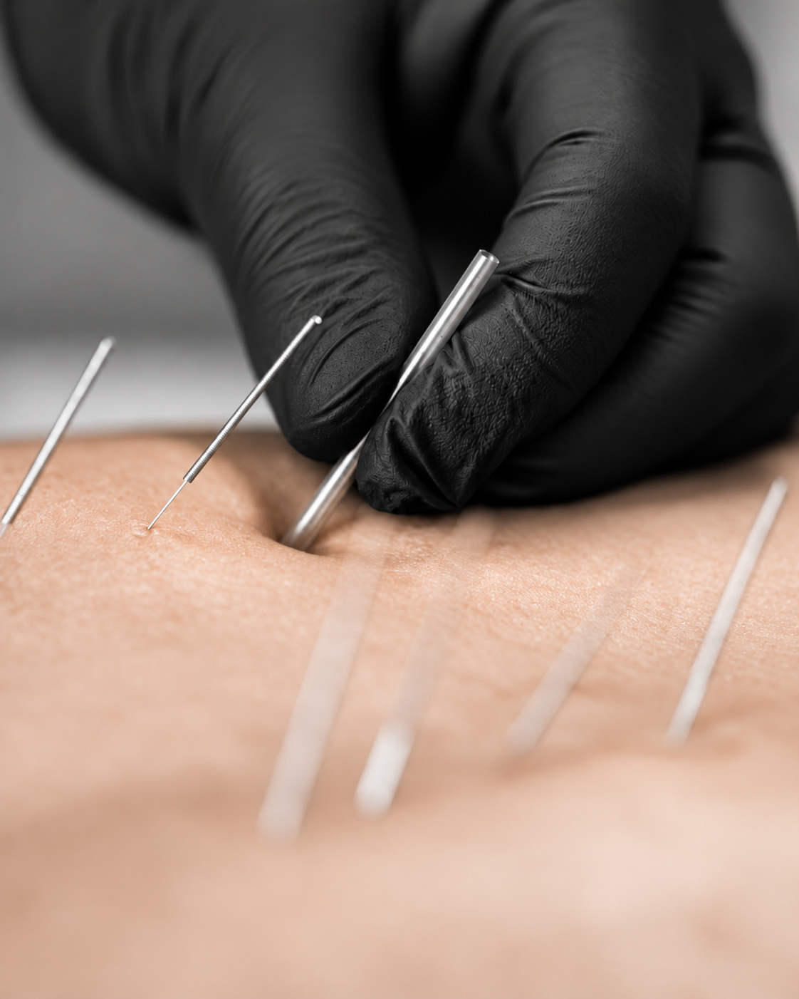 A close-up of an acupuncture procedure with a practitioner wearing black gloves inserting thin needles into a person's skin on their back.