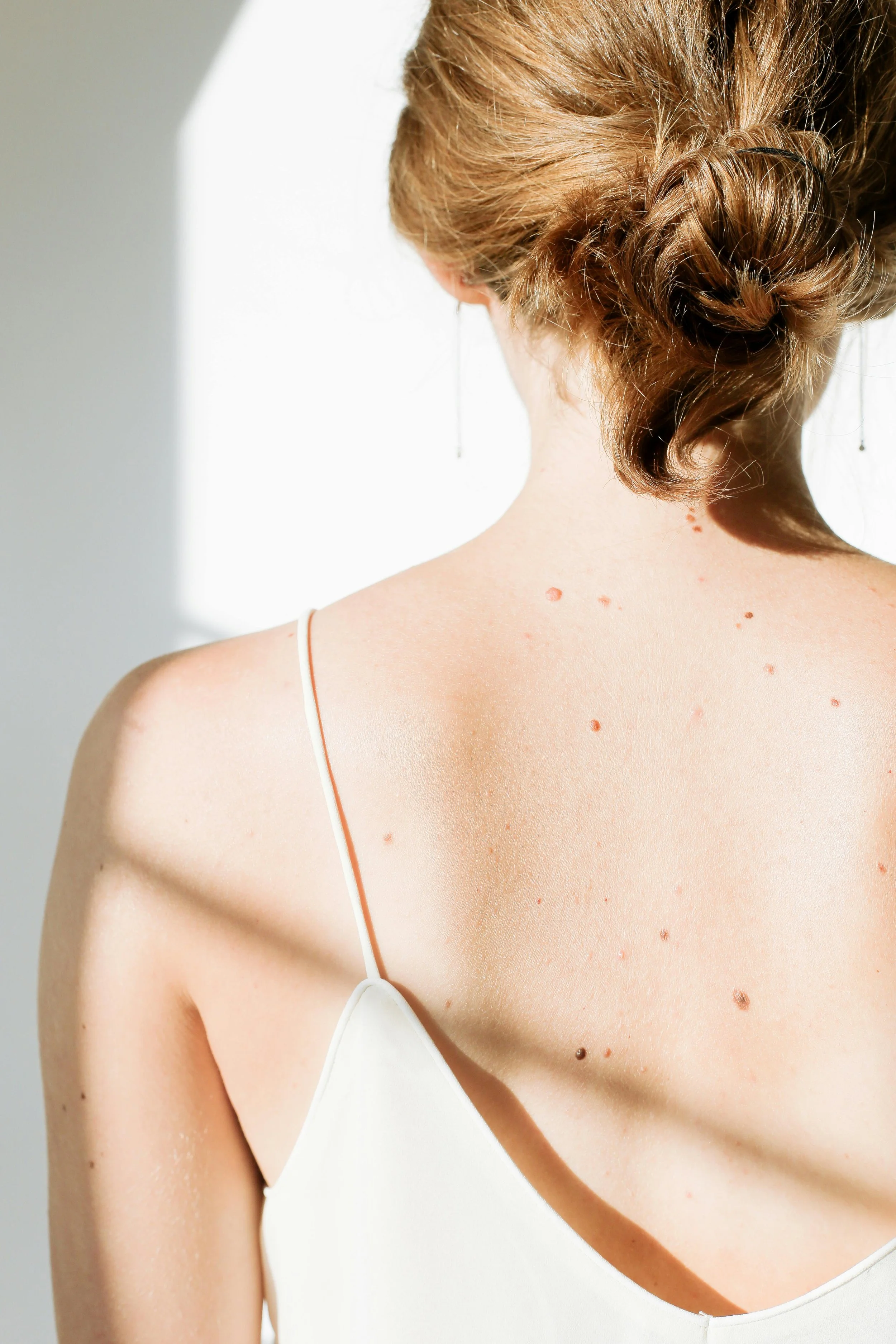 A woman with light skin and brown hair styled in a loose bun, seen from behind, wearing a white spaghetti strap top, with multiple moles and red spots on her skin.