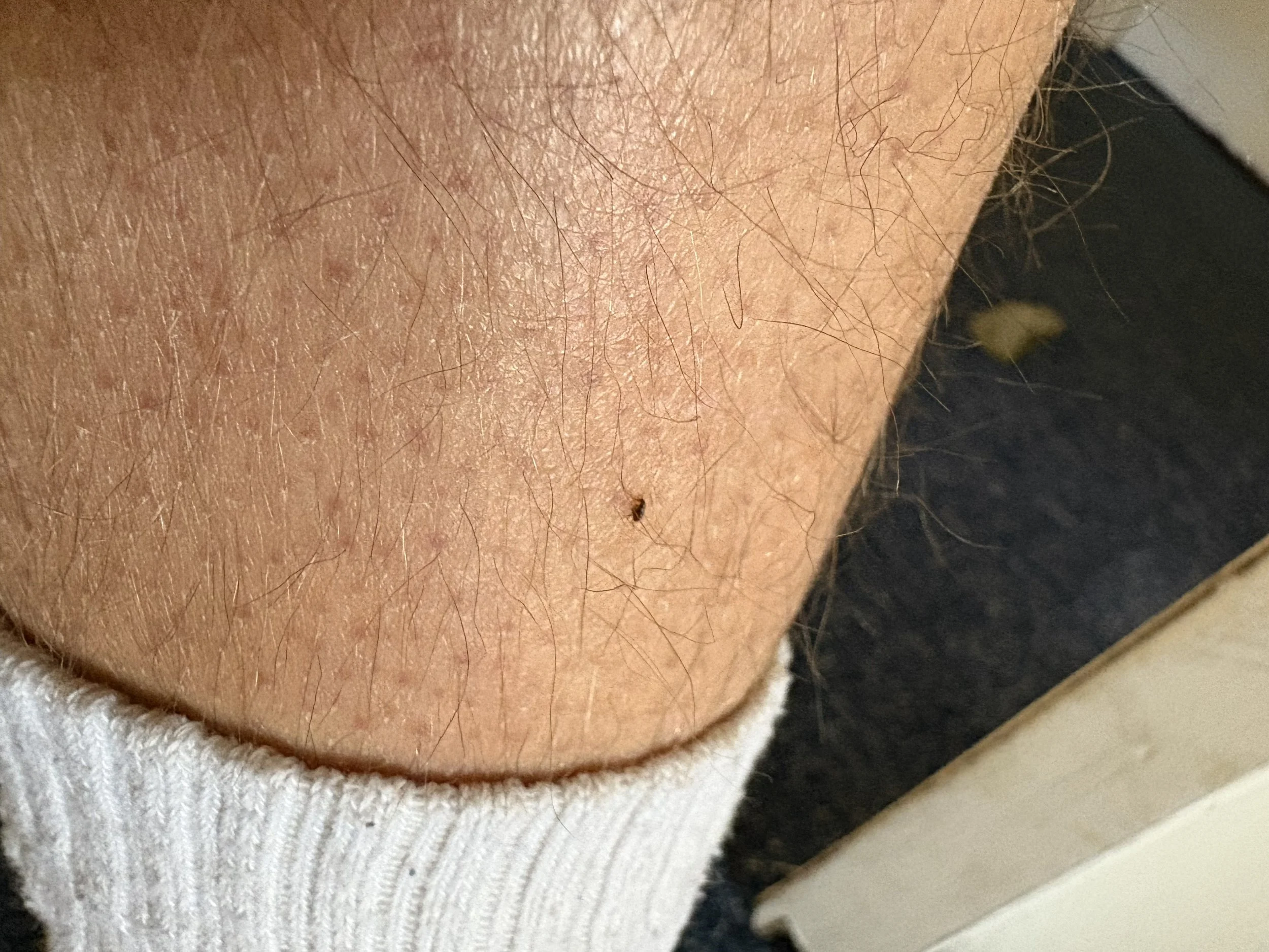 Close-up of a person's skin with small hair and a tiny black mole or insect on the skin.