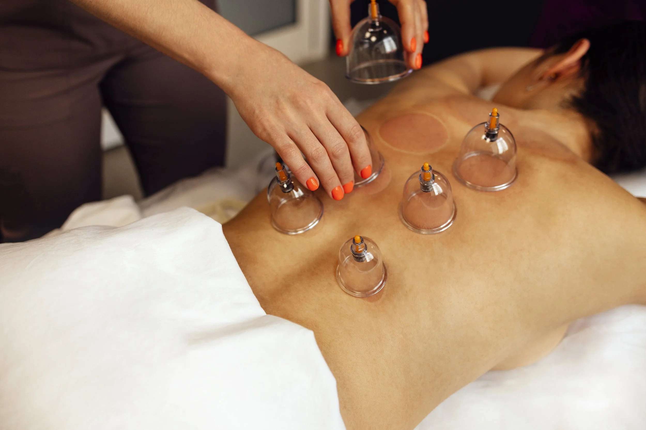 A person having a cupping therapy treatment on their back with multiple cups placed on their skin.