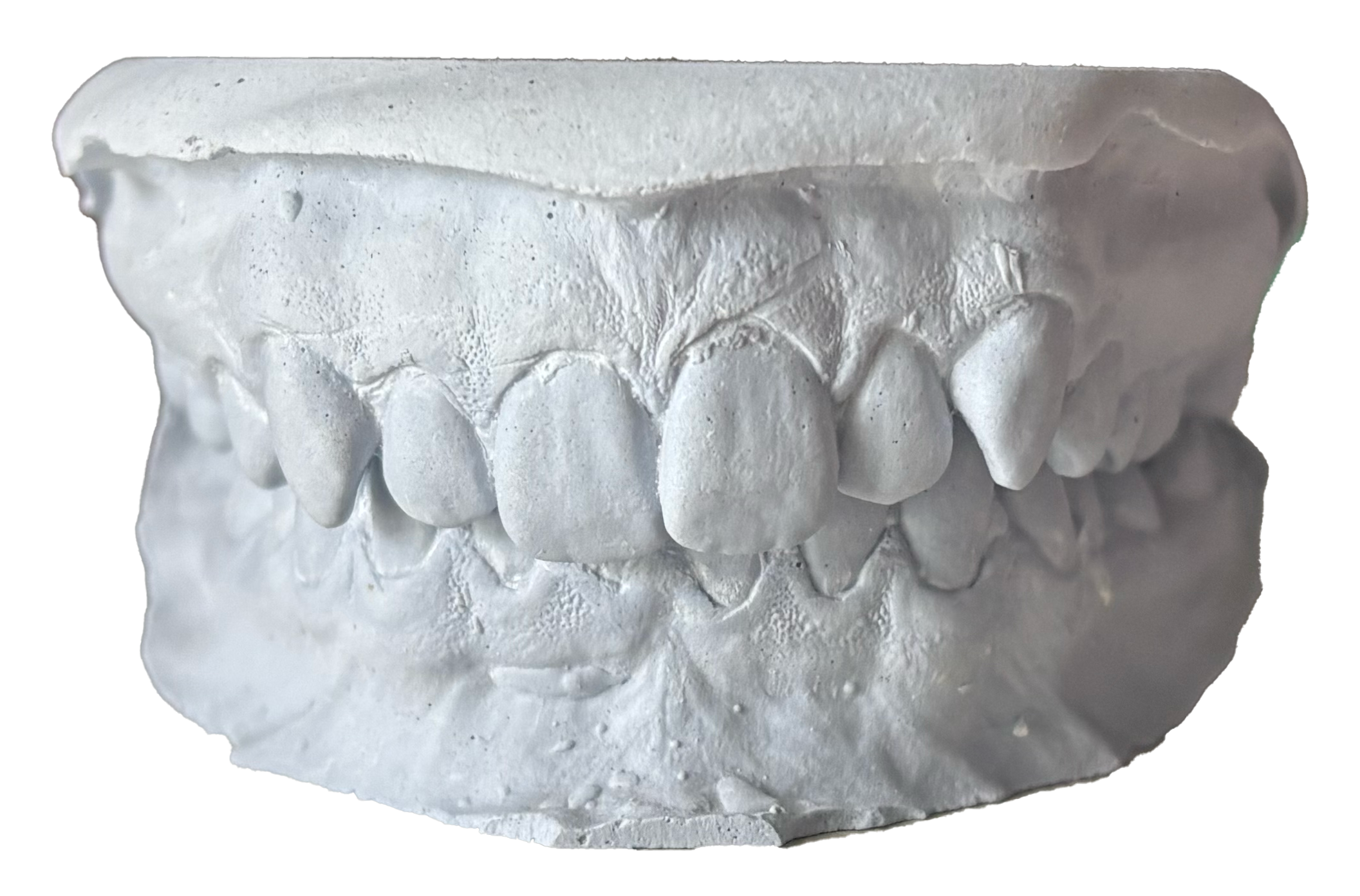 White plaster cast of a human set of teeth and gums.