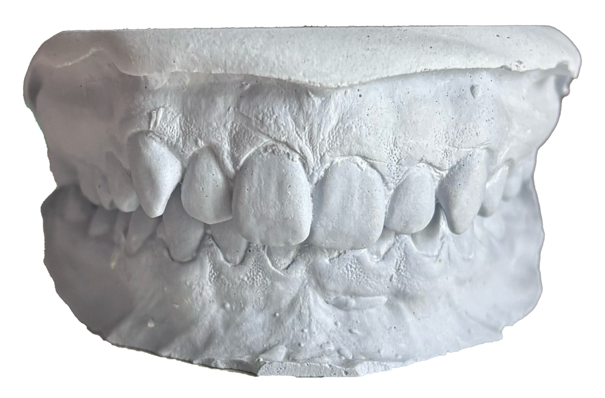 A white dental model showing the upper and lower teeth and gums.