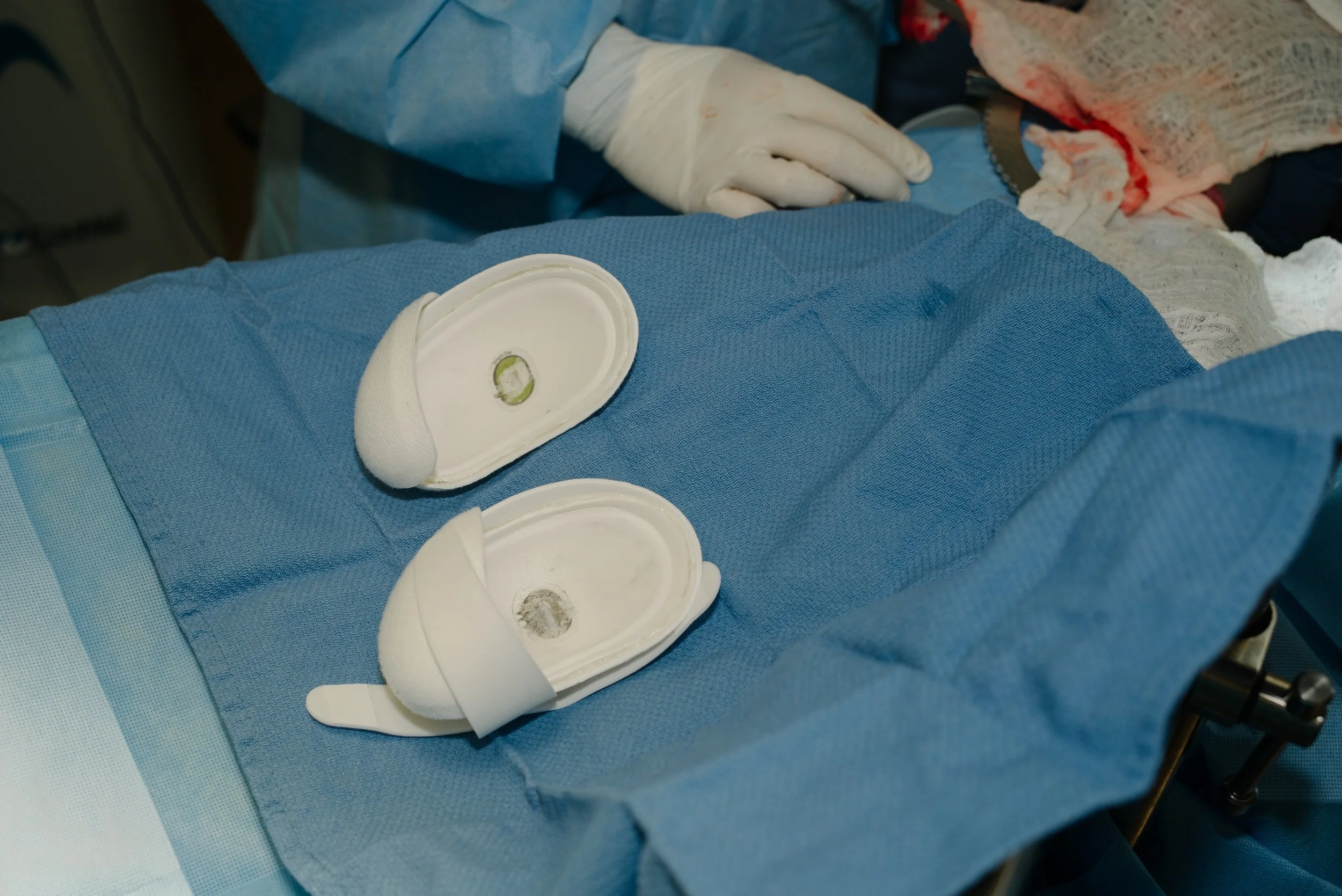 Two closed and open silicone breast implants on a blue surgical drape during a procedure.