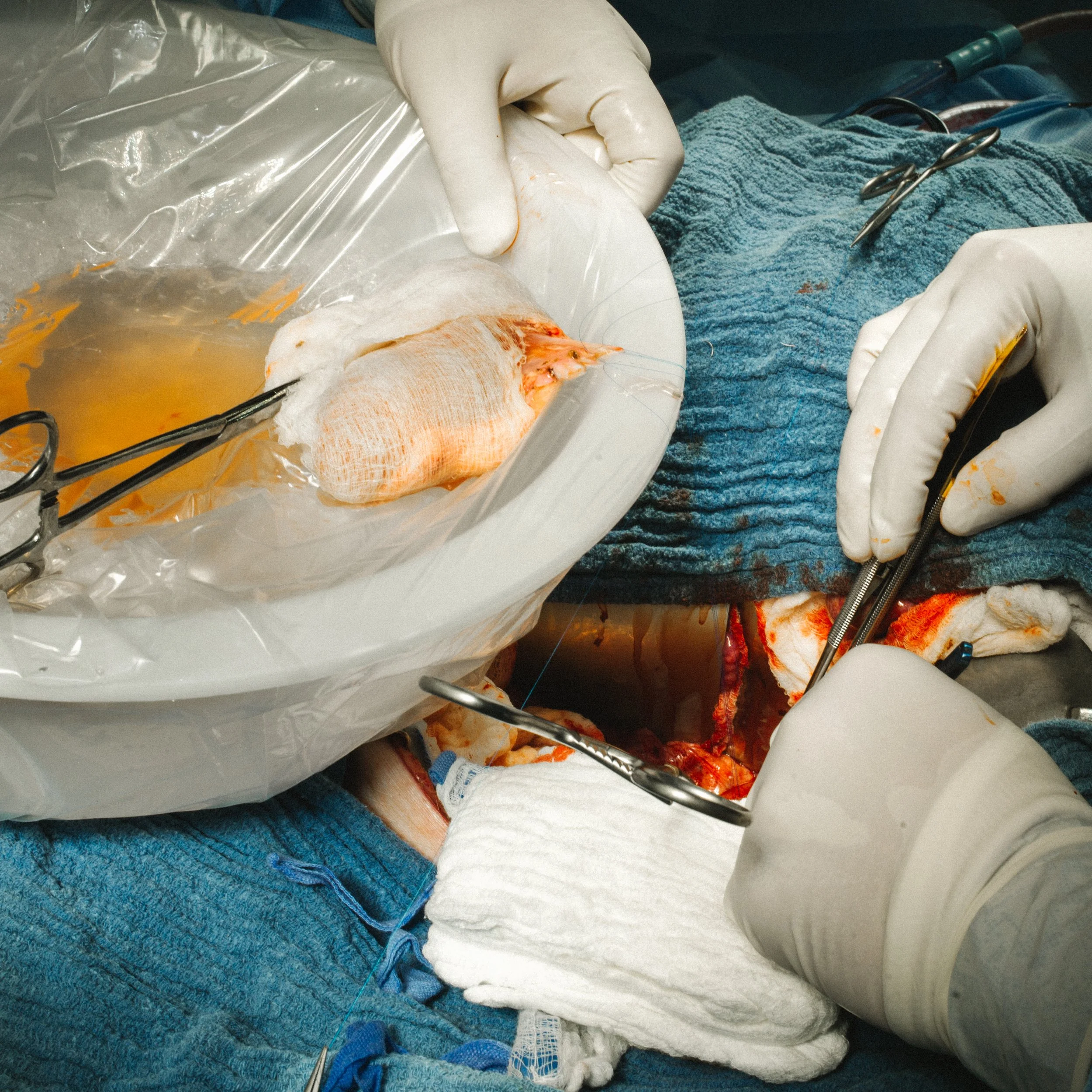 Surgeons perform surgery on a patient's chest, wearing gloves and using surgical instruments.