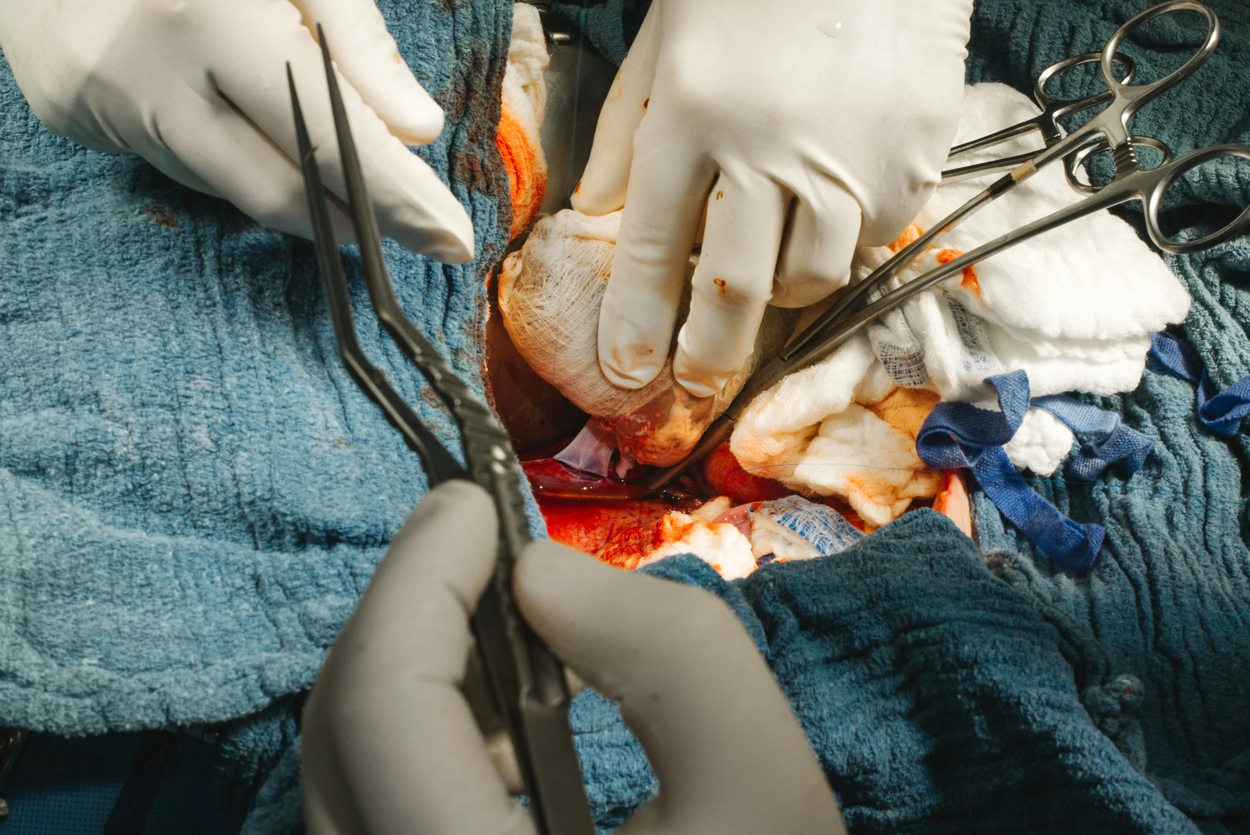 Surgeons performing an operation with sterile gloves, surgical tools, and medical supplies visible around the surgical field.