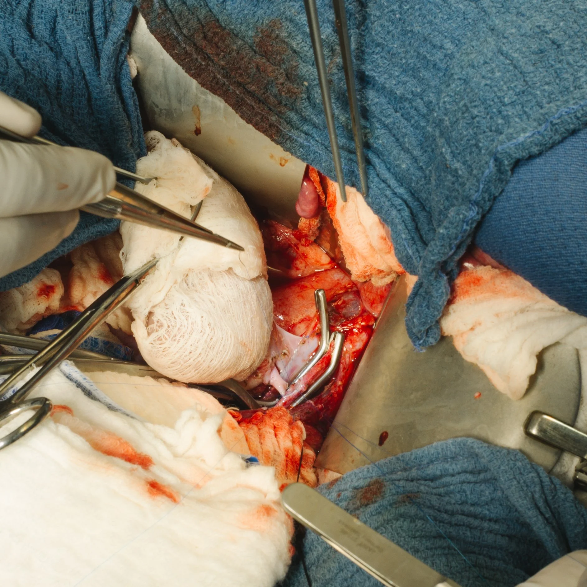 Image of a surgical procedure with medical instruments, gauze, and tissue visible in an operating room.