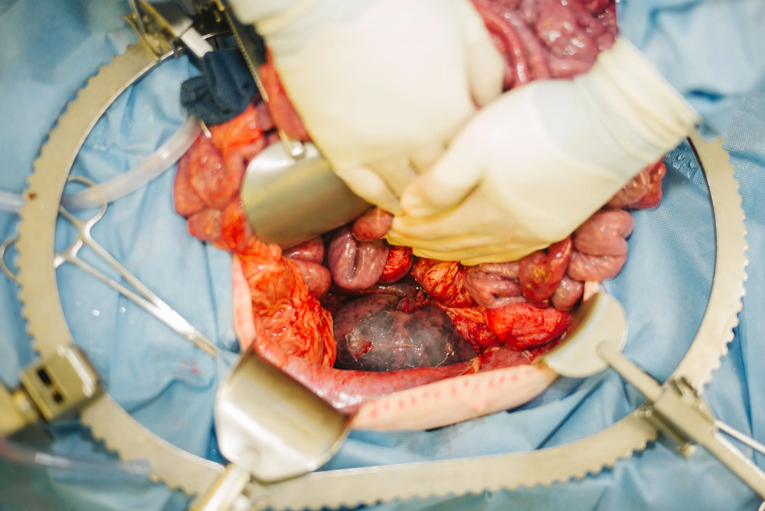 A surgical procedure showing exposed organs and tissues inside a patient's abdomen, with surgical tools and a drape surrounding the area.