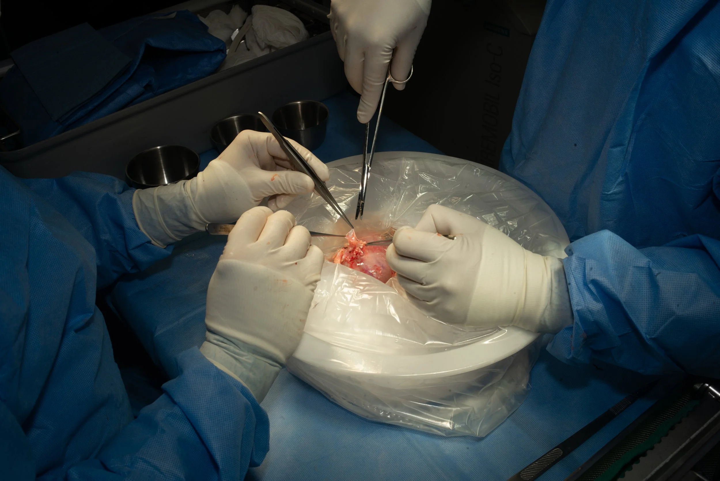Medical team performing surgery with three surgeons in blue scrubs and gloves, using surgical instruments on a prepared patient, with a sterile drape and surgical tools nearby.