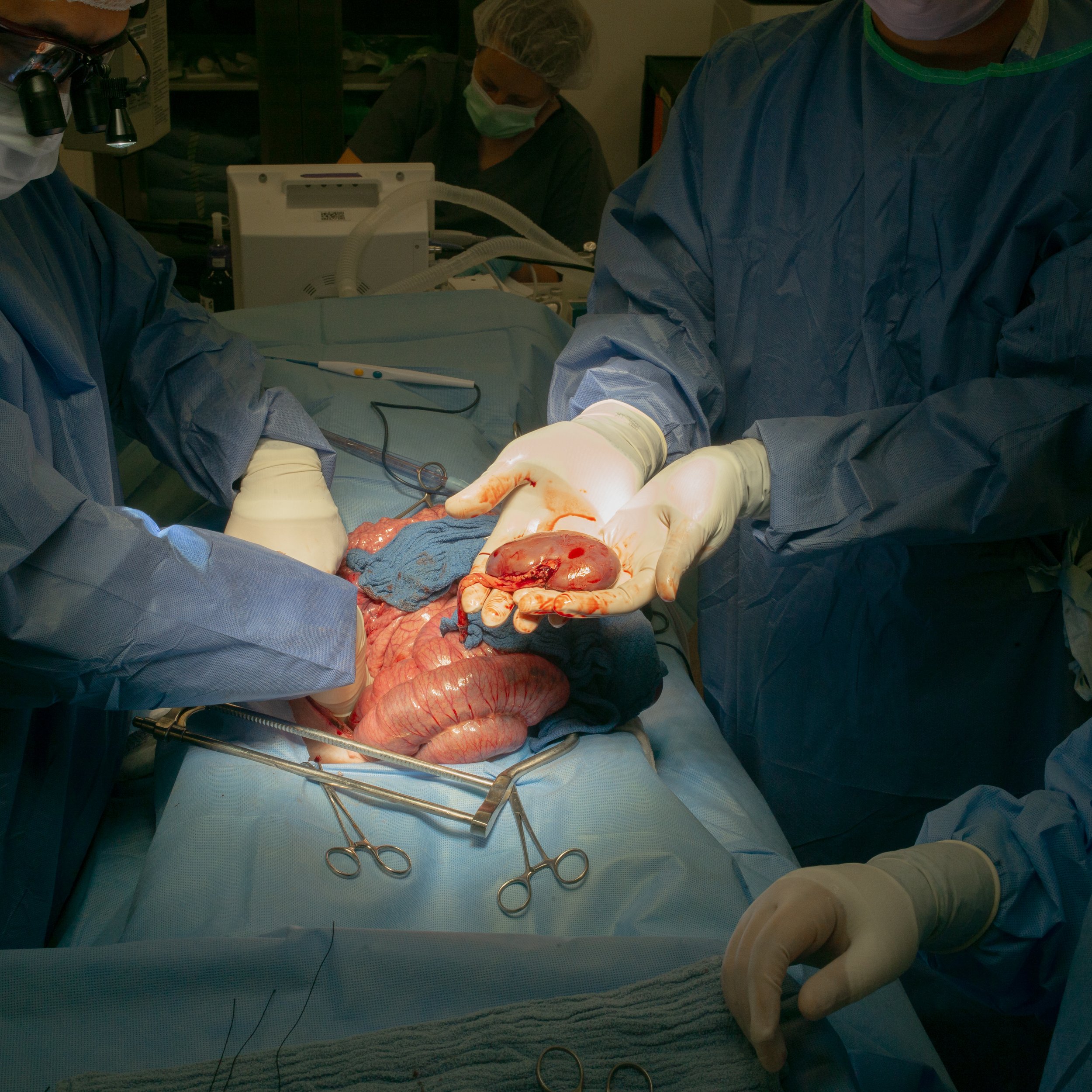 Medical team performing surgery on a patient, holding a removed organ, with surgical instruments on the drape.