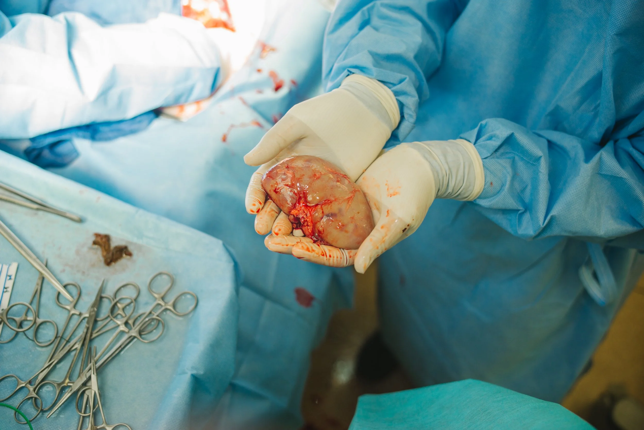 Medical professional wearing gloves holding a preserved human kidney during surgery, with surgical tools on a blue surgical tray nearby.