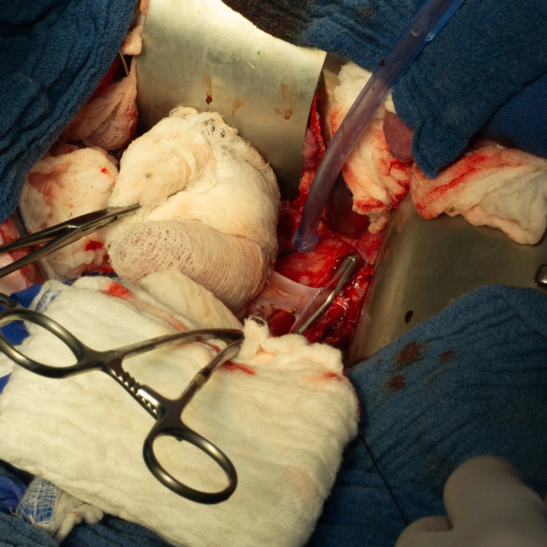 A close-up view of a surgical procedure, showing sterilized surgical instruments, blood-soaked gauze, and medical drapes around the open surgical site.