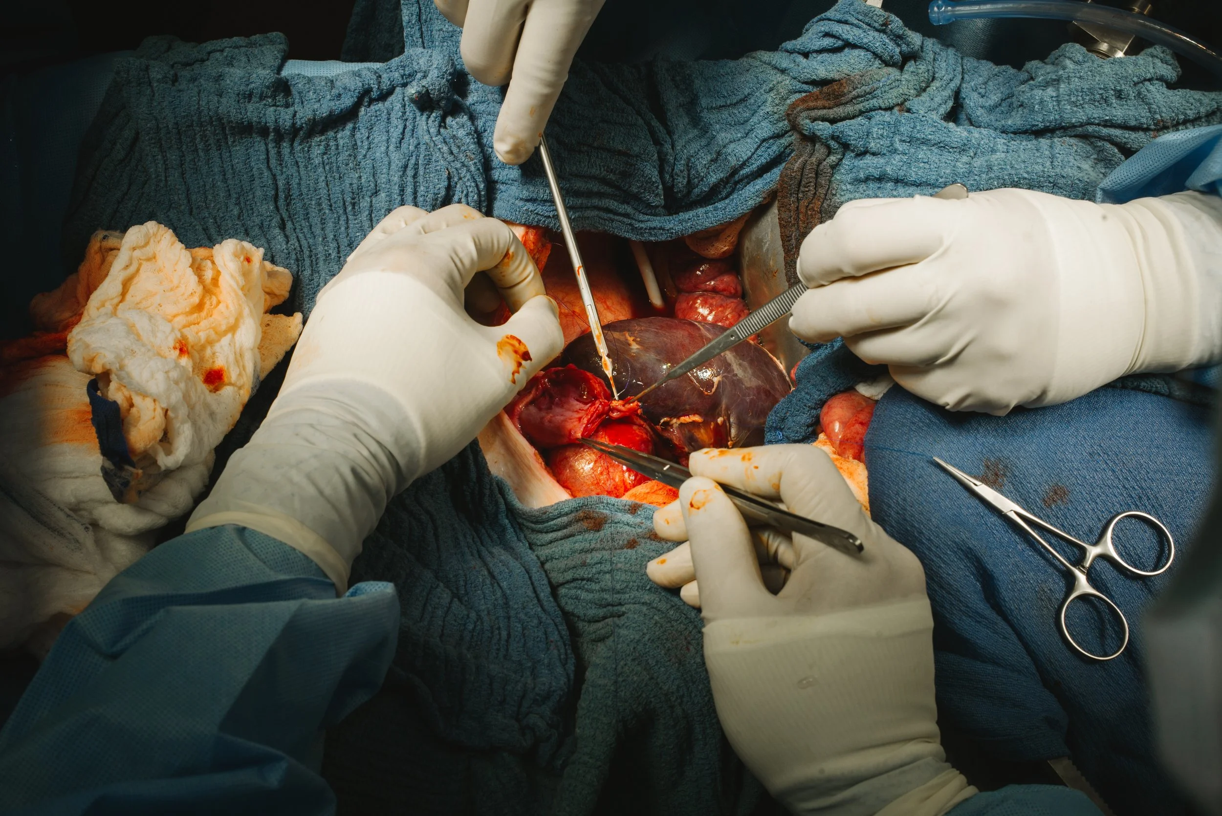 Surgeons performing an open-heart surgery, with hands holding surgical instruments and surrounding surgical materials.