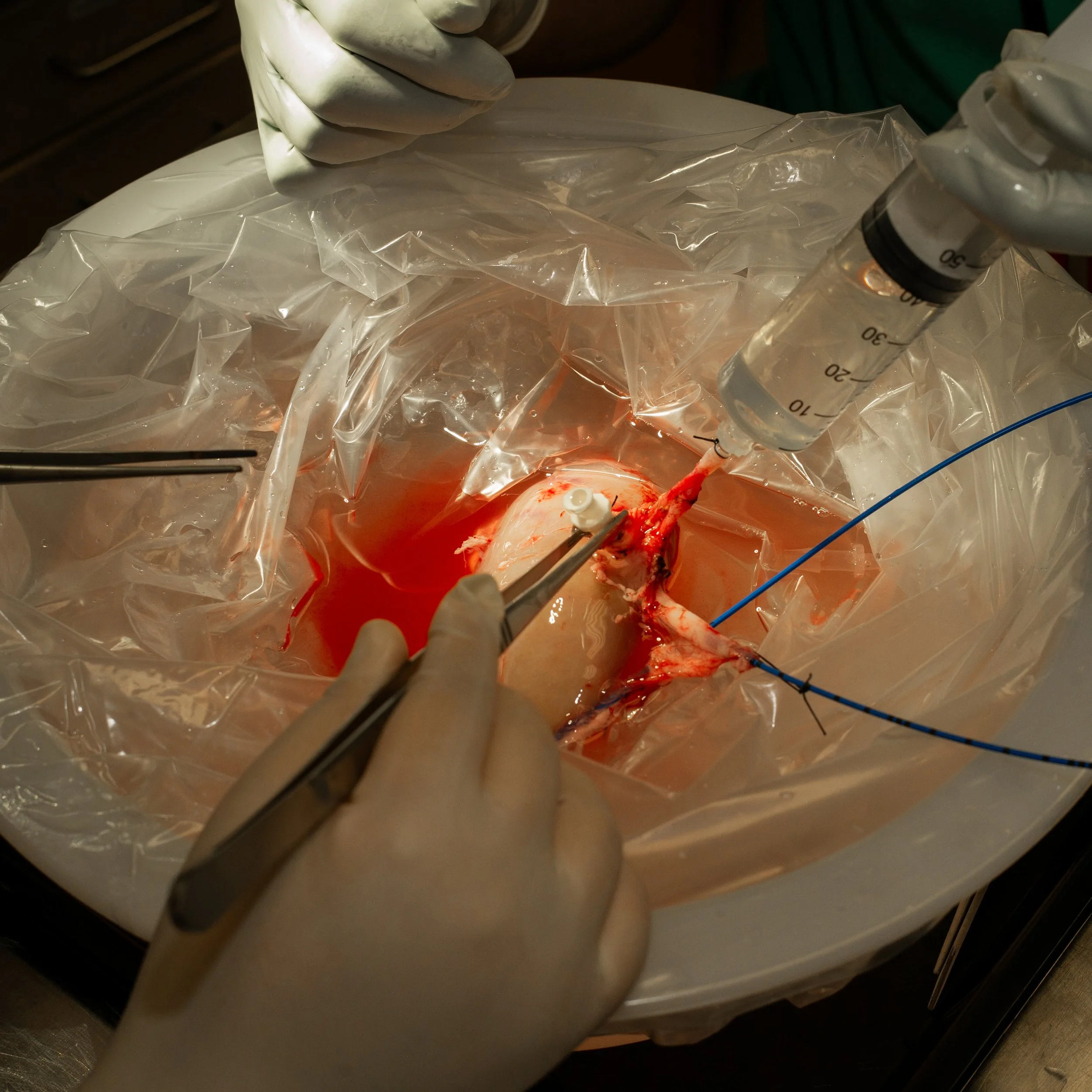 Surgical procedure on a heart with tools and syringes, sterile environment with gloves and medical equipment.