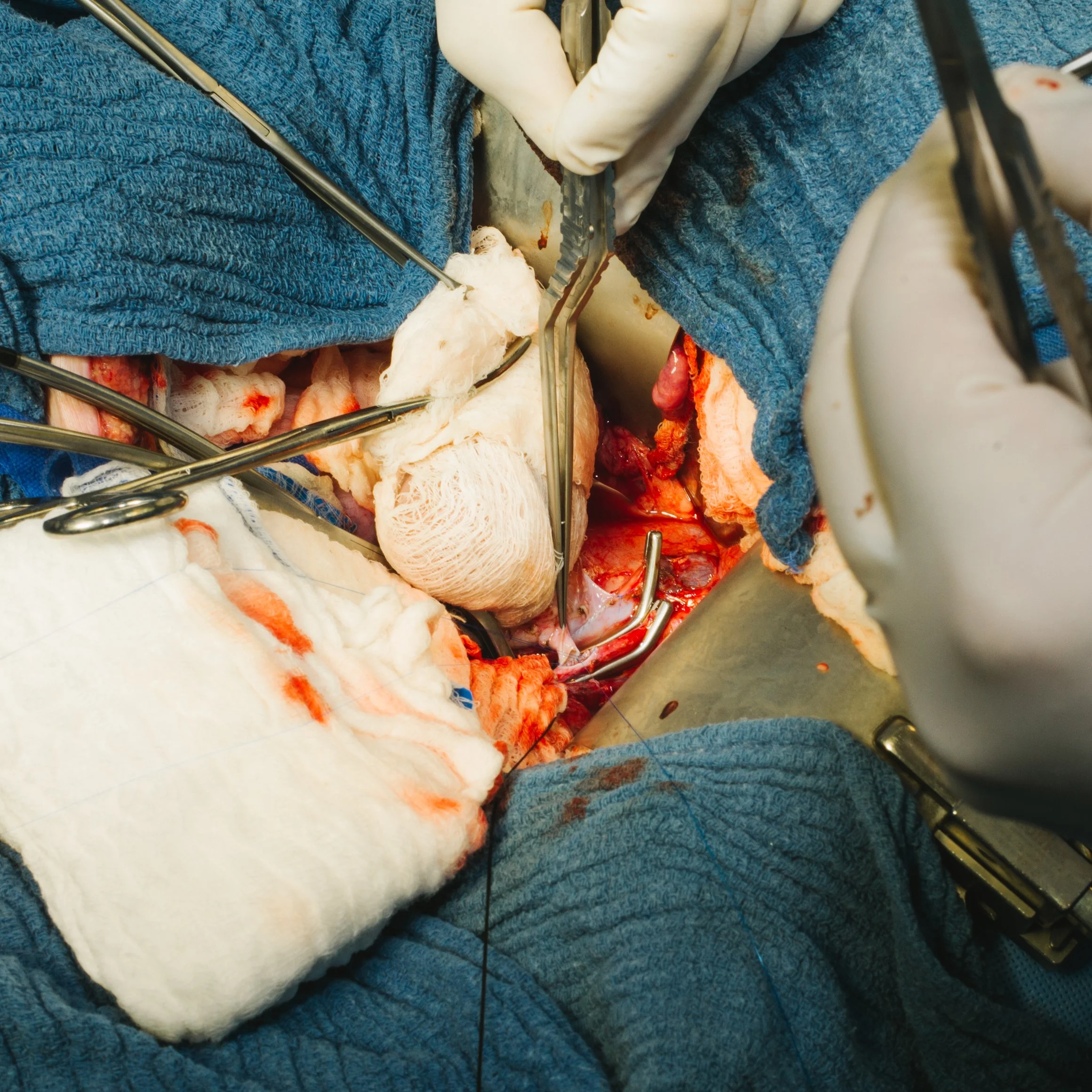 An open-heart surgery in progress with various surgical tools and medical supplies visible around the patient's chest.