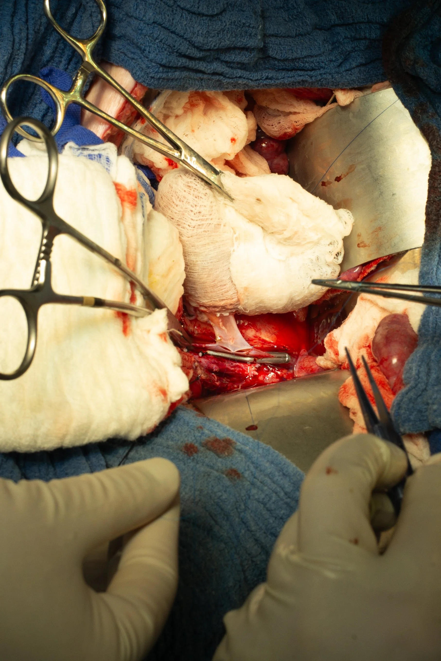 A surgical operation in progress with surgical tools, sterile drapes, and exposed tissue.