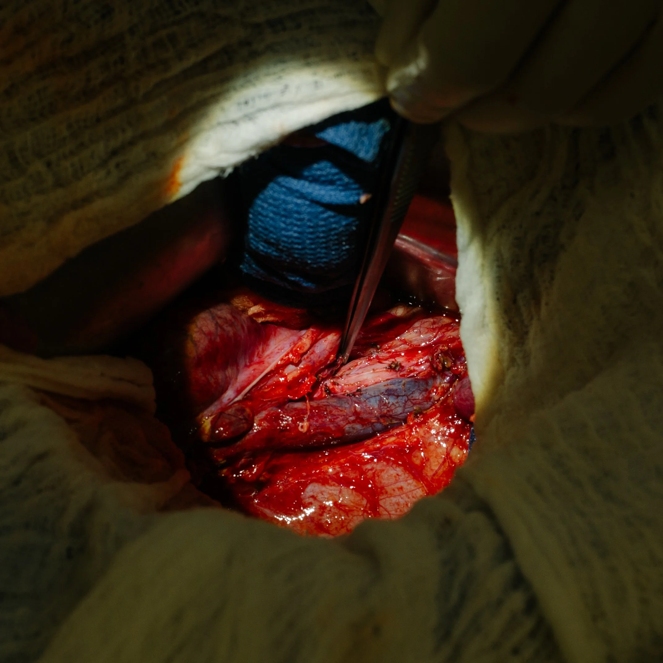 A close-up view of an open surgical site inside a patient's body, with surgical tools and exposed tissues visible.