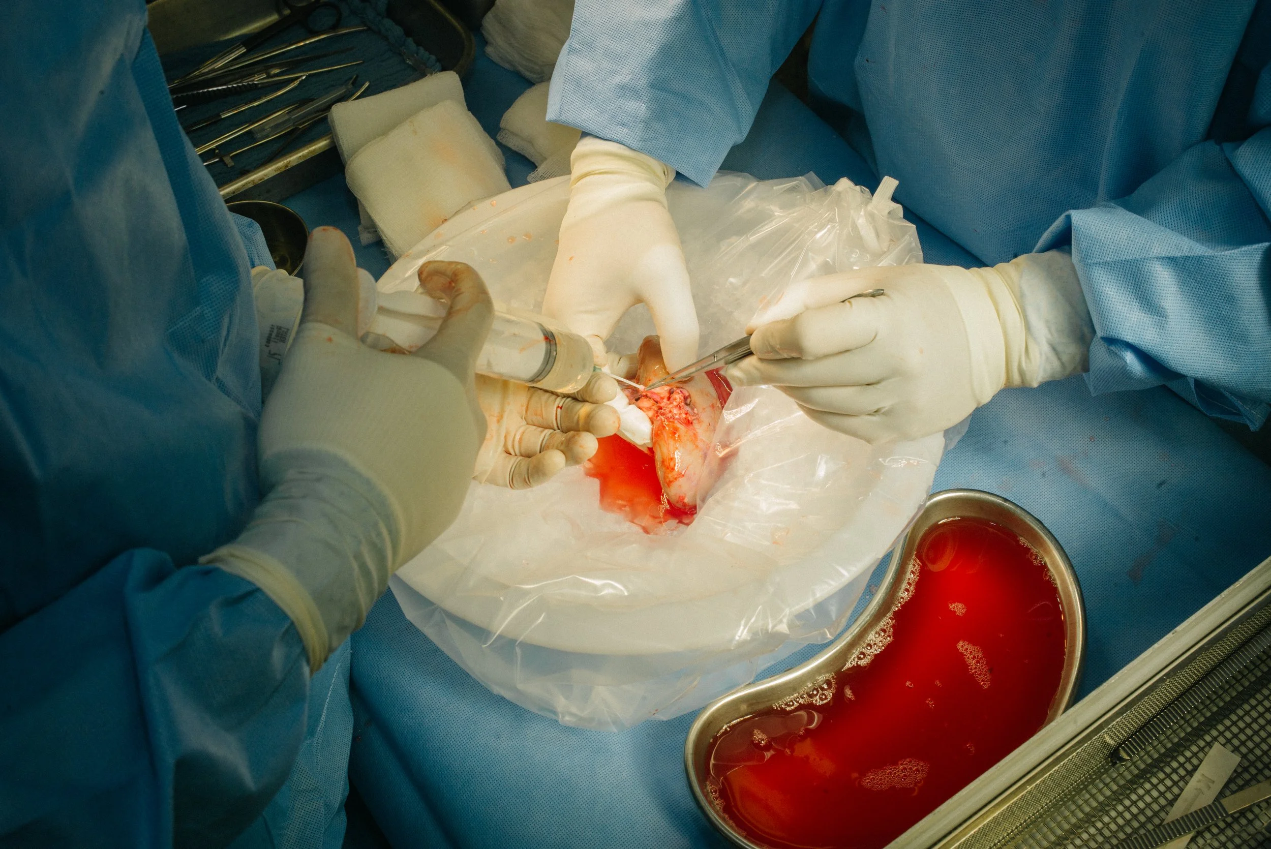 Surgeons performing an operation in an operating room, using surgical tools and a syringe with blood, with sterile surrounding environment.