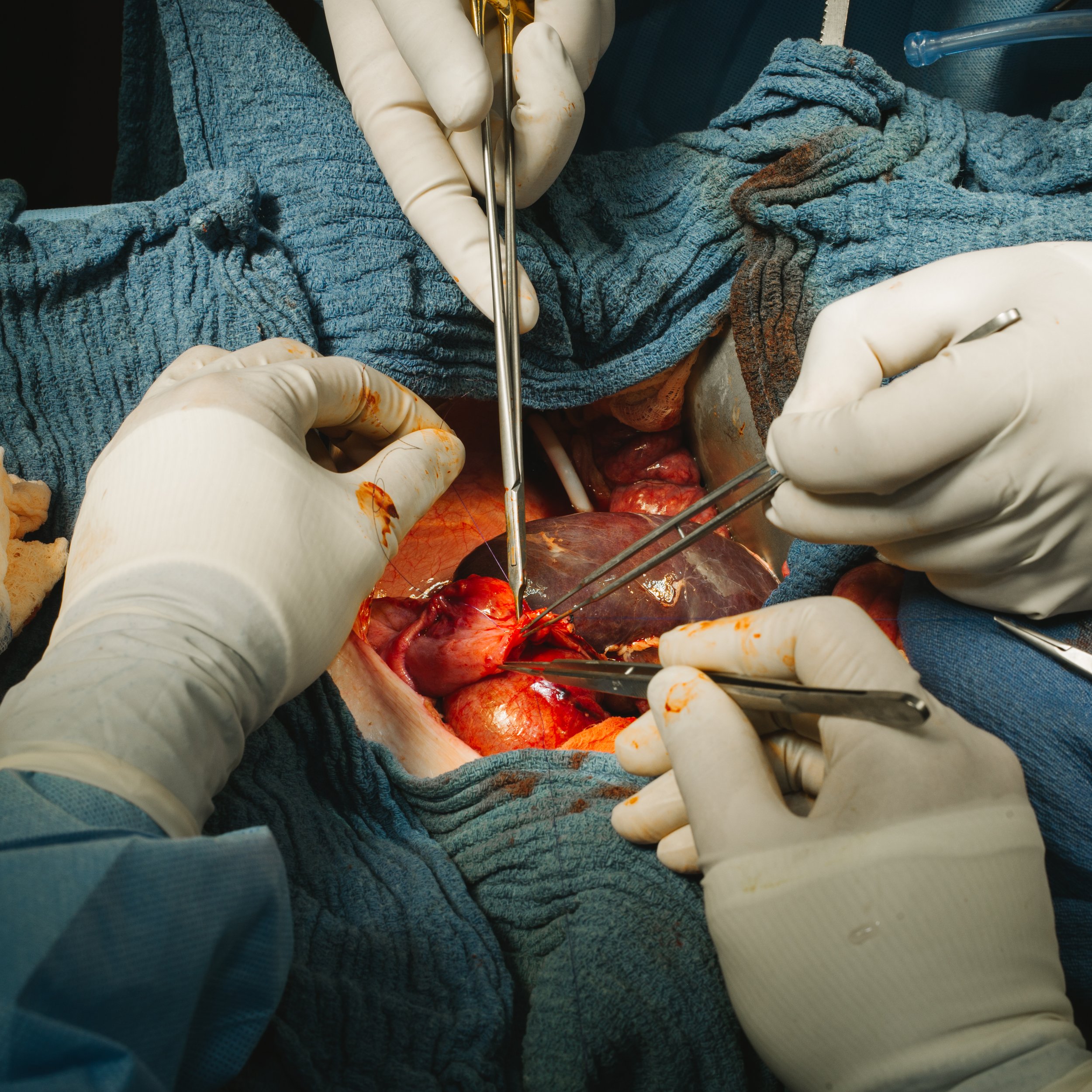 Surgeons wearing gloves performing an open-heart surgery, holding surgical instruments around the patient's chest.