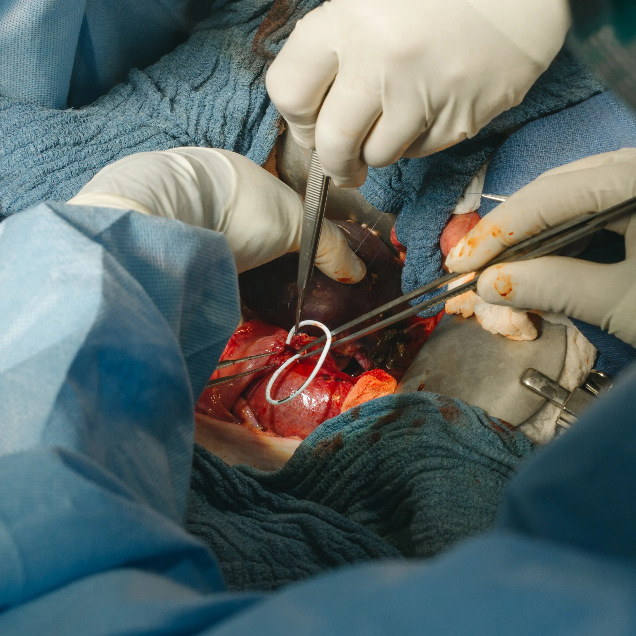 Surgeons performing open-heart surgery with surgical tools inside the chest cavity.