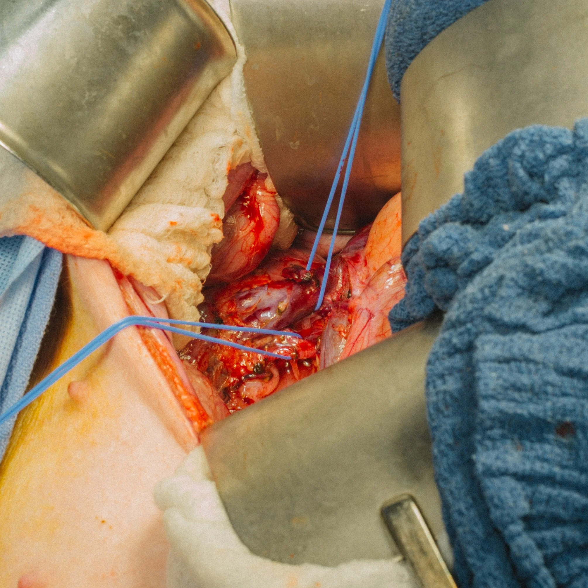 Open surgical procedure showing exposed internal organs with surgical instruments and blue retractors.