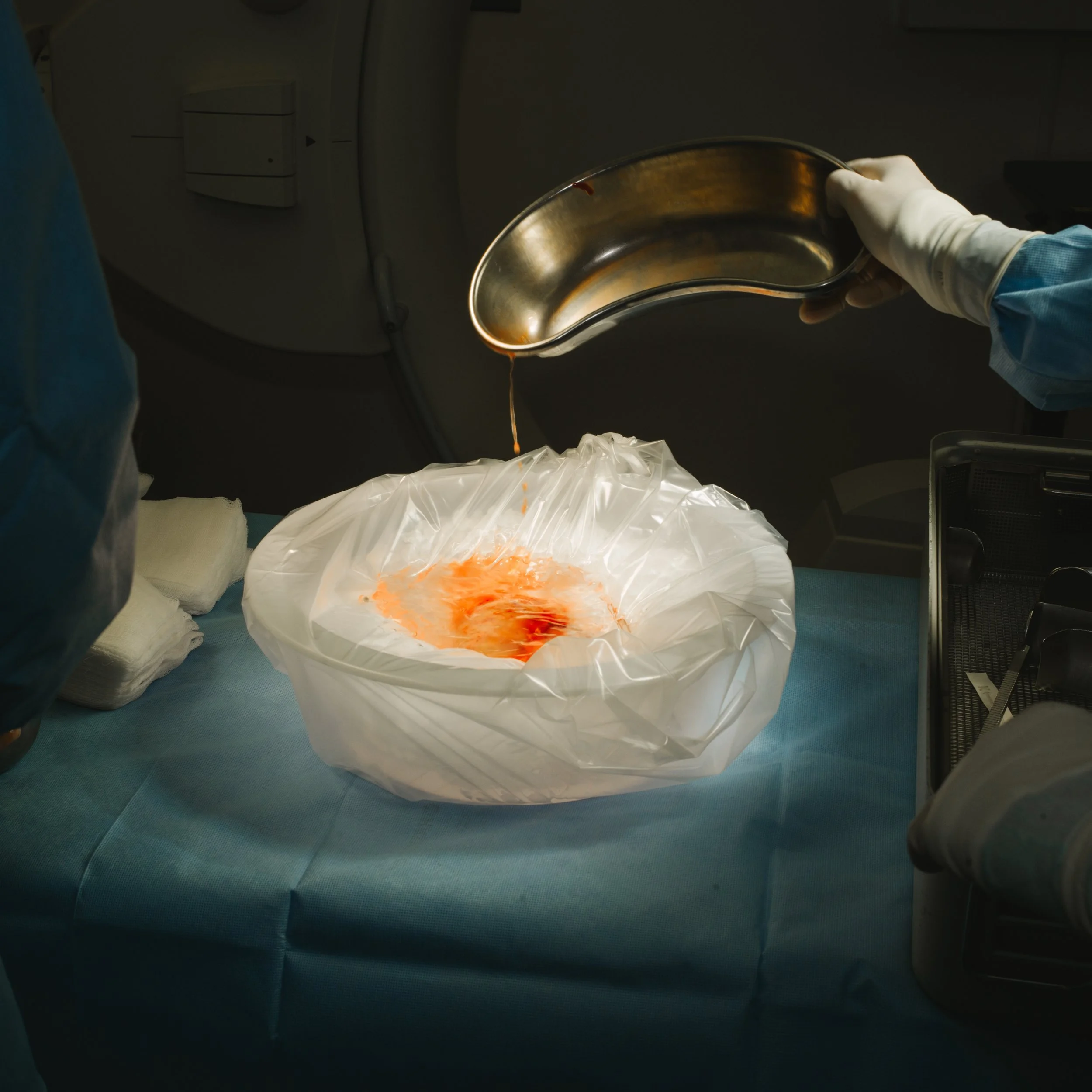 Medical professional pouring blood or fluid into a sterile collection bag covered with a plastic liner in a clinical setting.