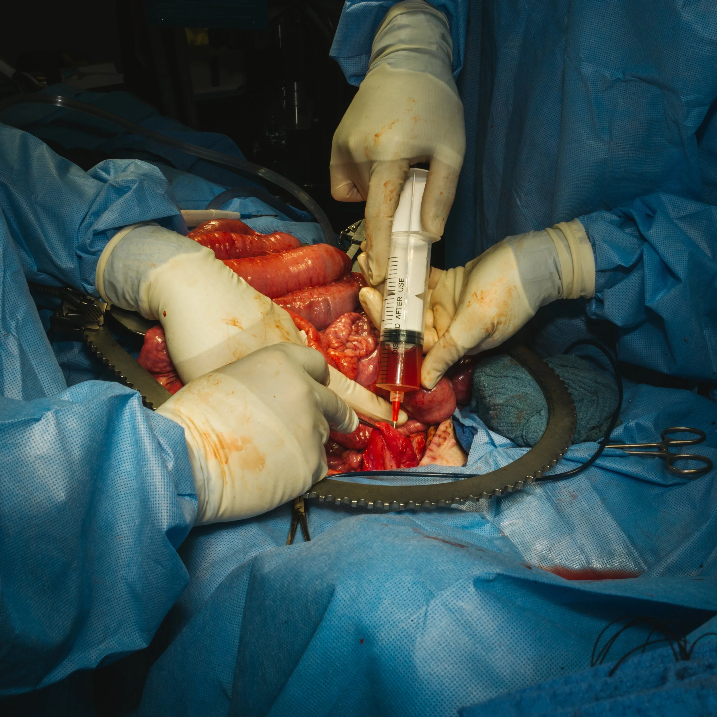 Surgeons in blue gowns and gloves perform abdominal surgery, using a syringe and tools to work on the intestines.