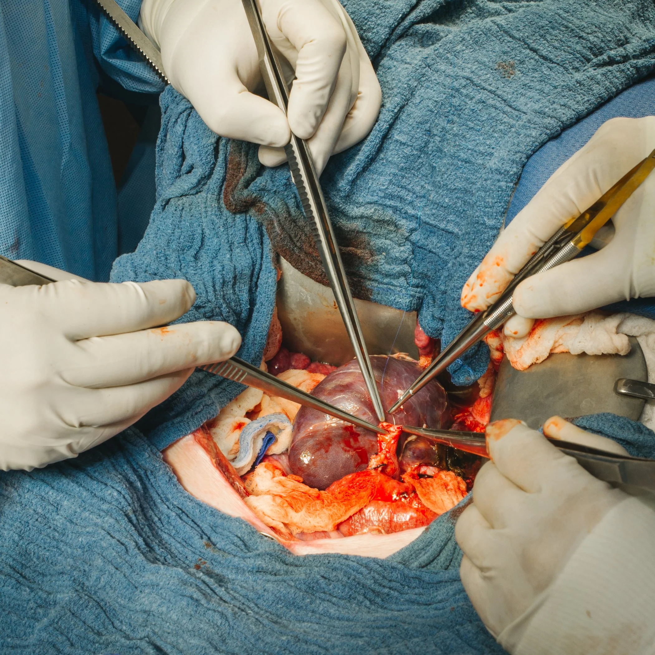 Surgeons performing a cardiac surgery, with a heart exposed inside an open chest cavity, using surgical tools.