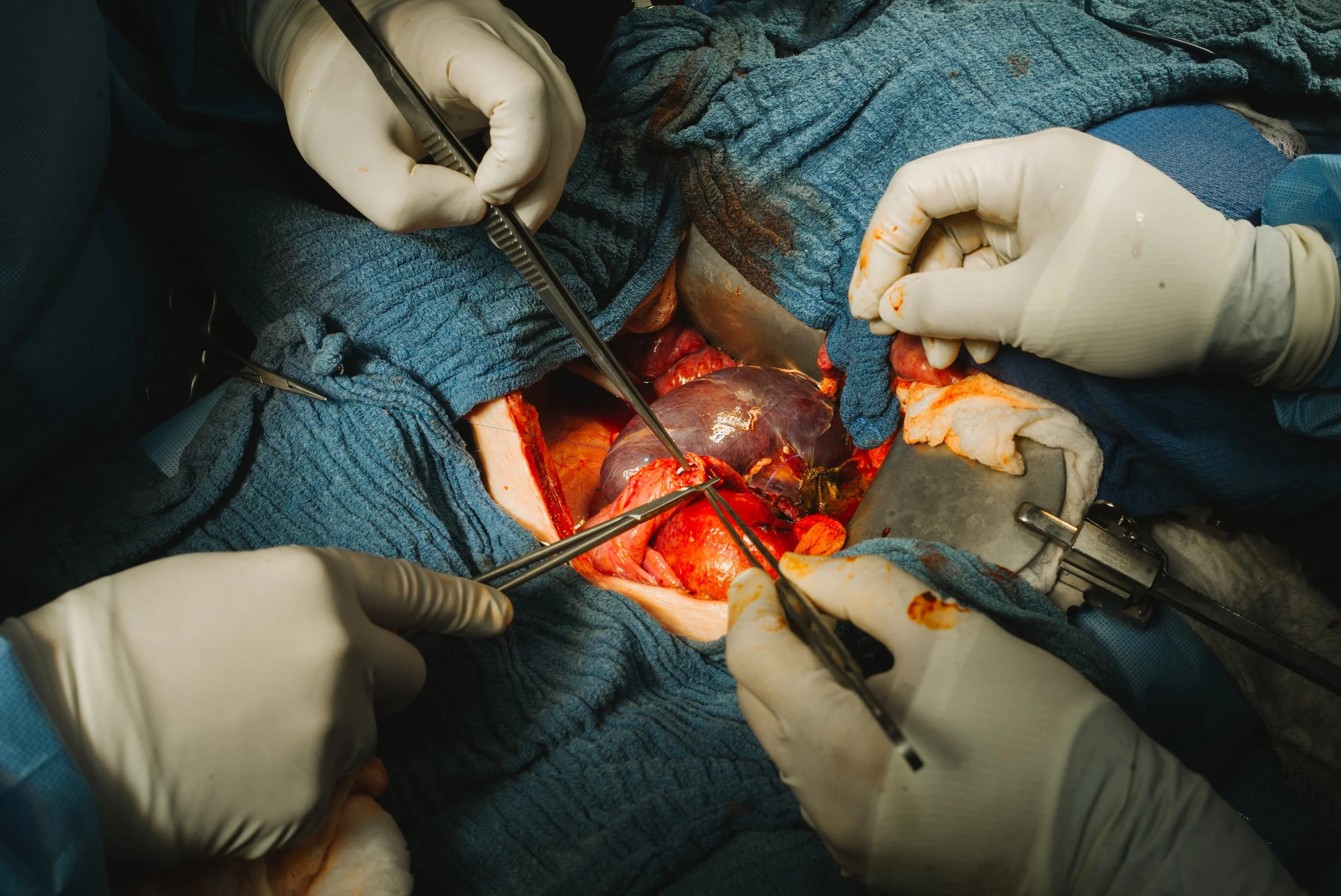 Surgeons performing open-heart surgery, with visible heart, surgical tools, and sterile environment.