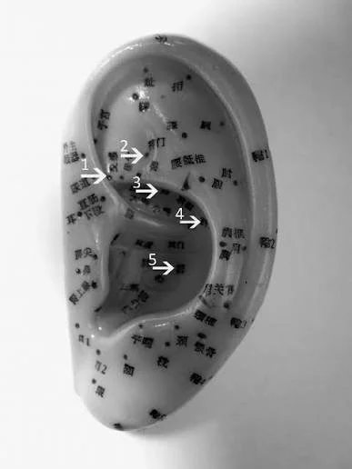 Acupuncture, Addiction Recovery, and the Five Needle Protocol: Ancient Medicine Meets Modern Recovery