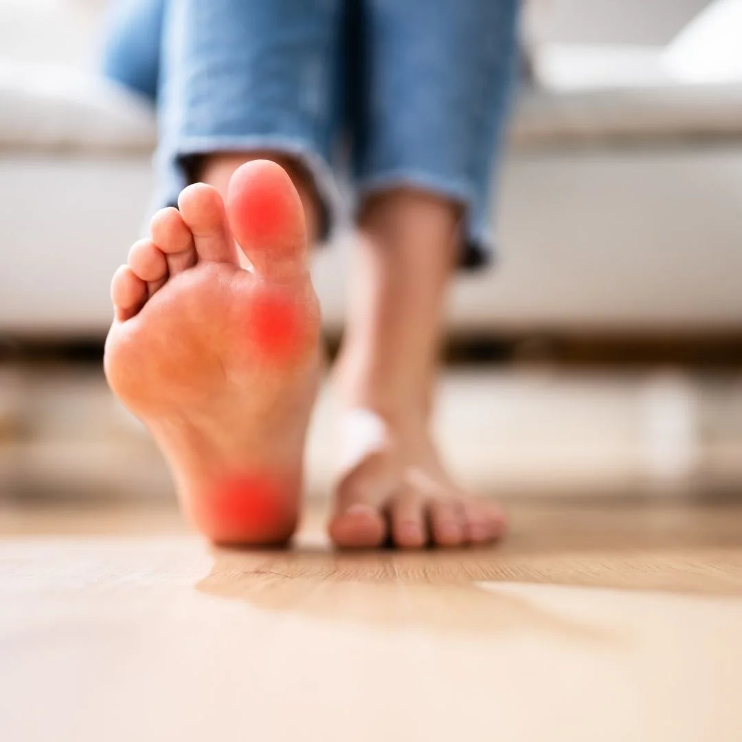 Close-up of a person's foot with red irritated areas on the heel and toes.